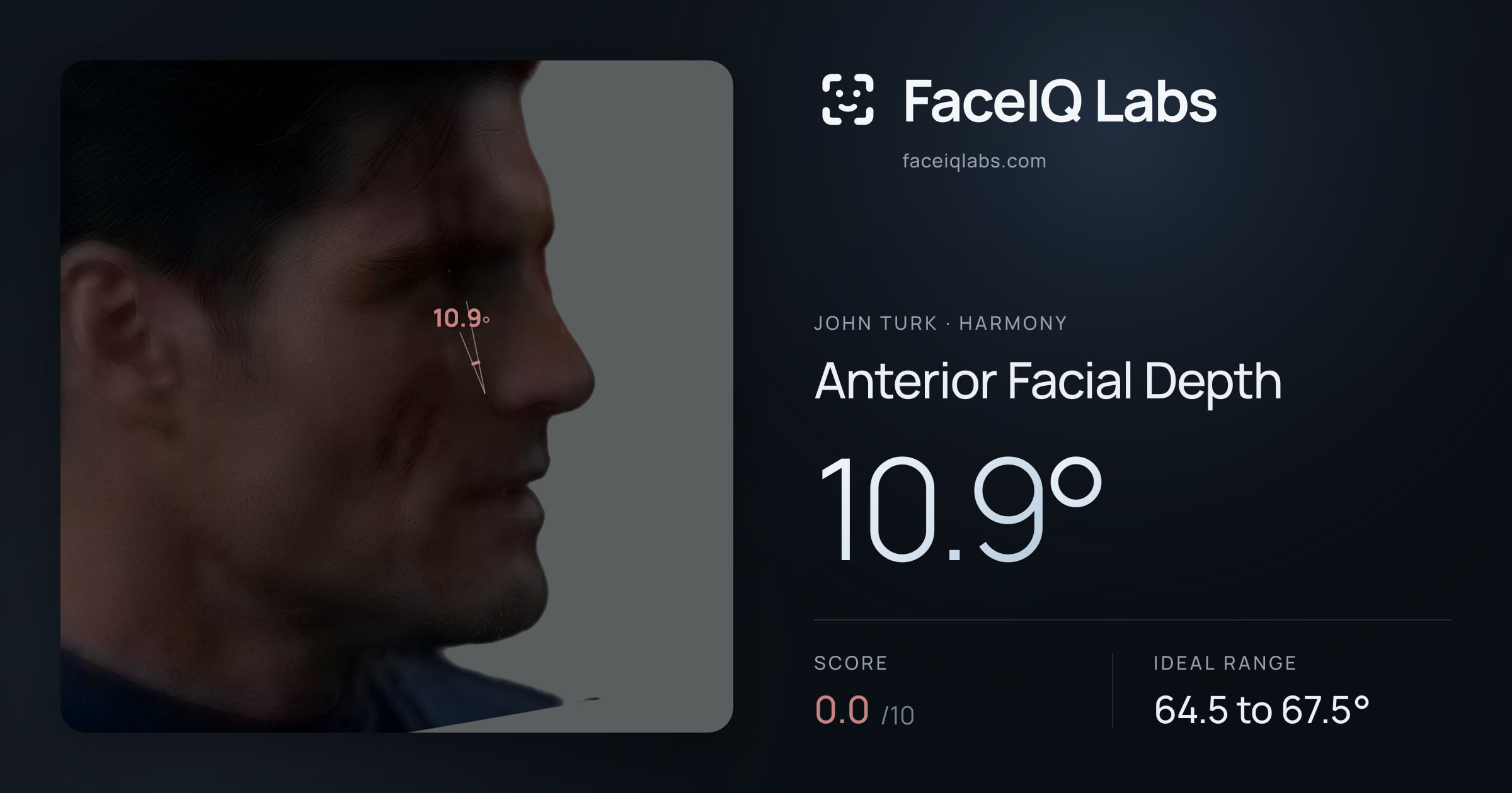 John Turk Anterior Facial Depth: 10.9°, drawn on the photo