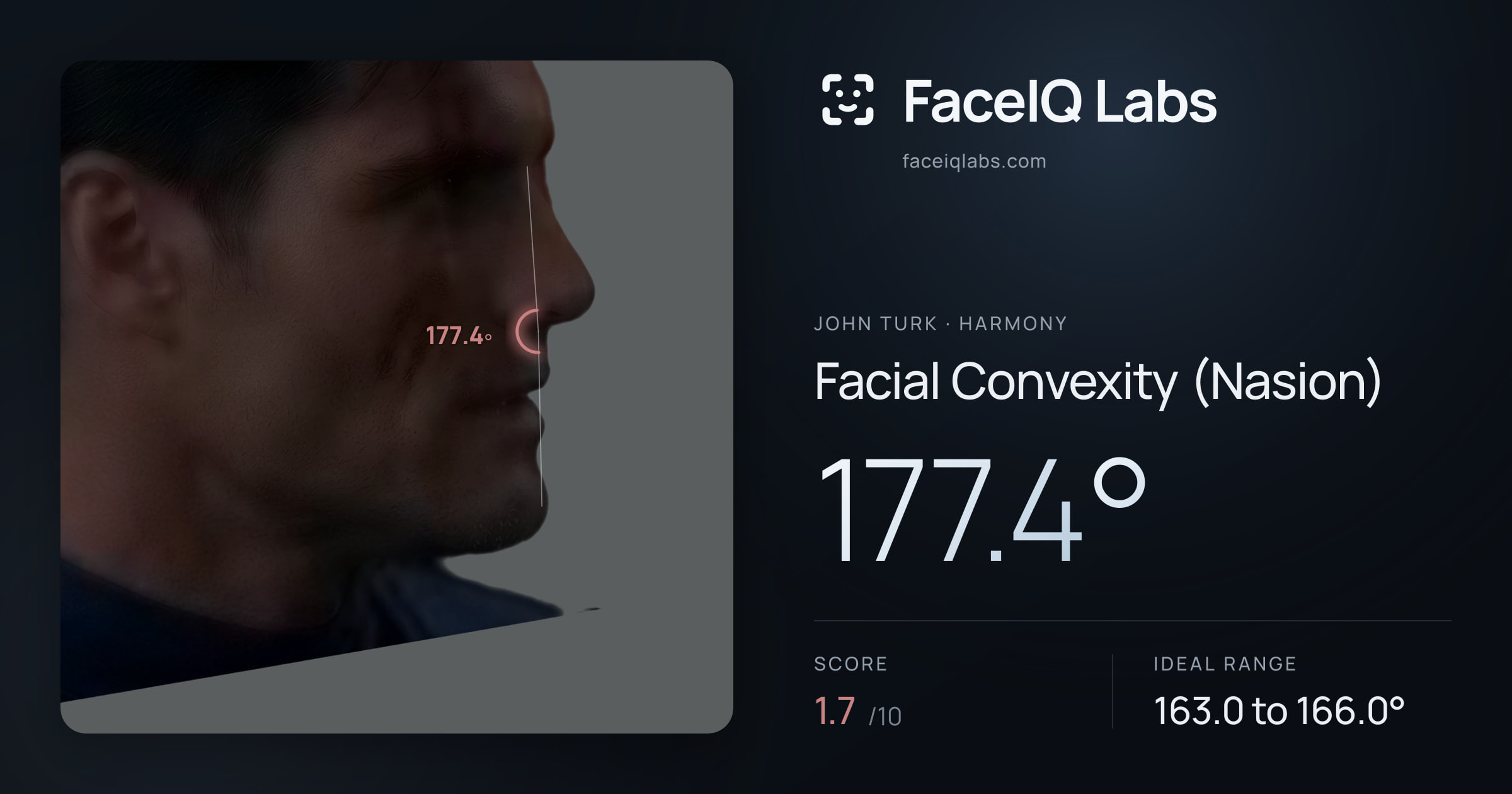 John Turk Facial Convexity (Nasion): 177.4°, drawn on the photo