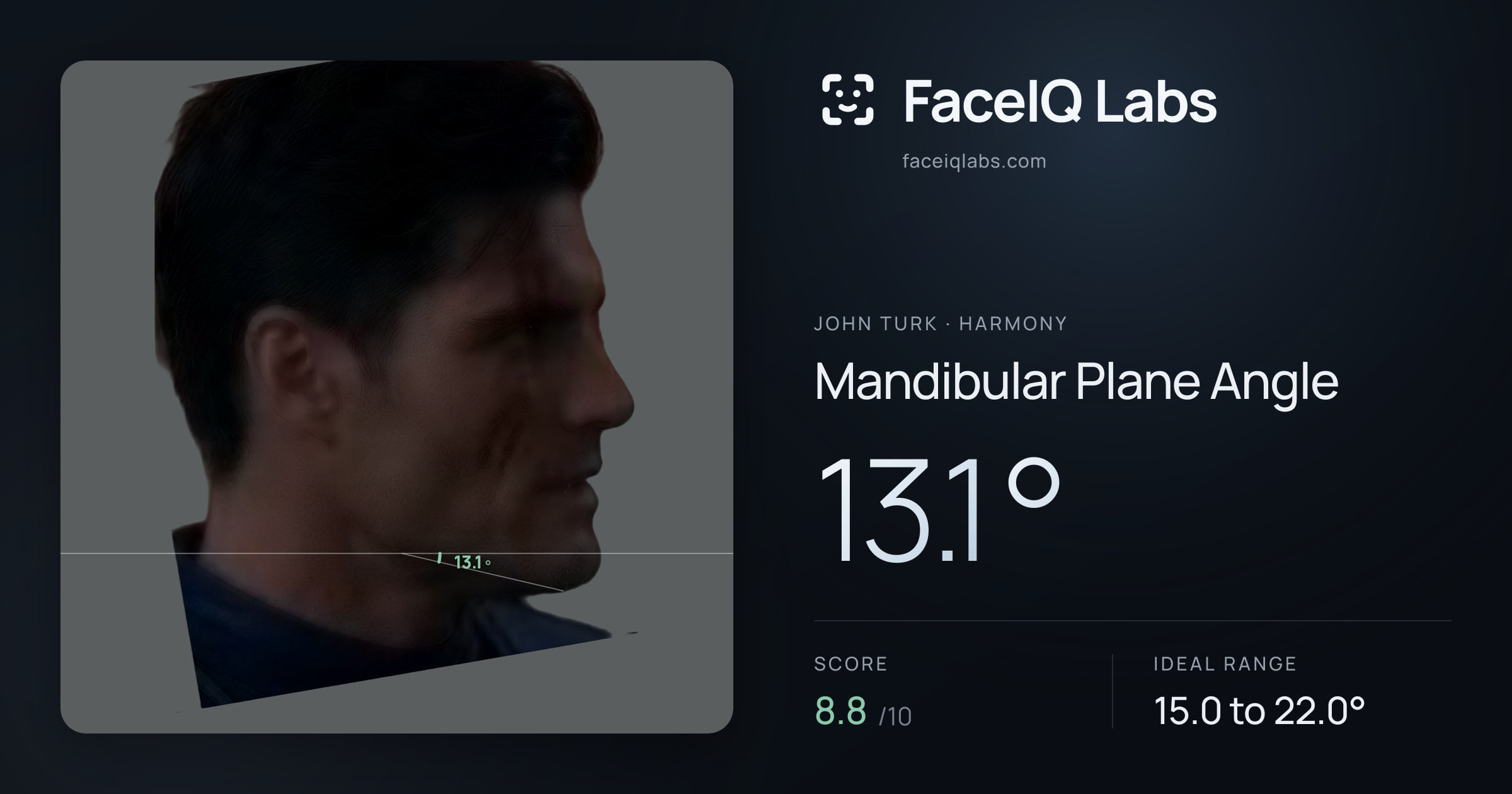 John Turk Mandibular Plane Angle: 13.1°, drawn on the photo