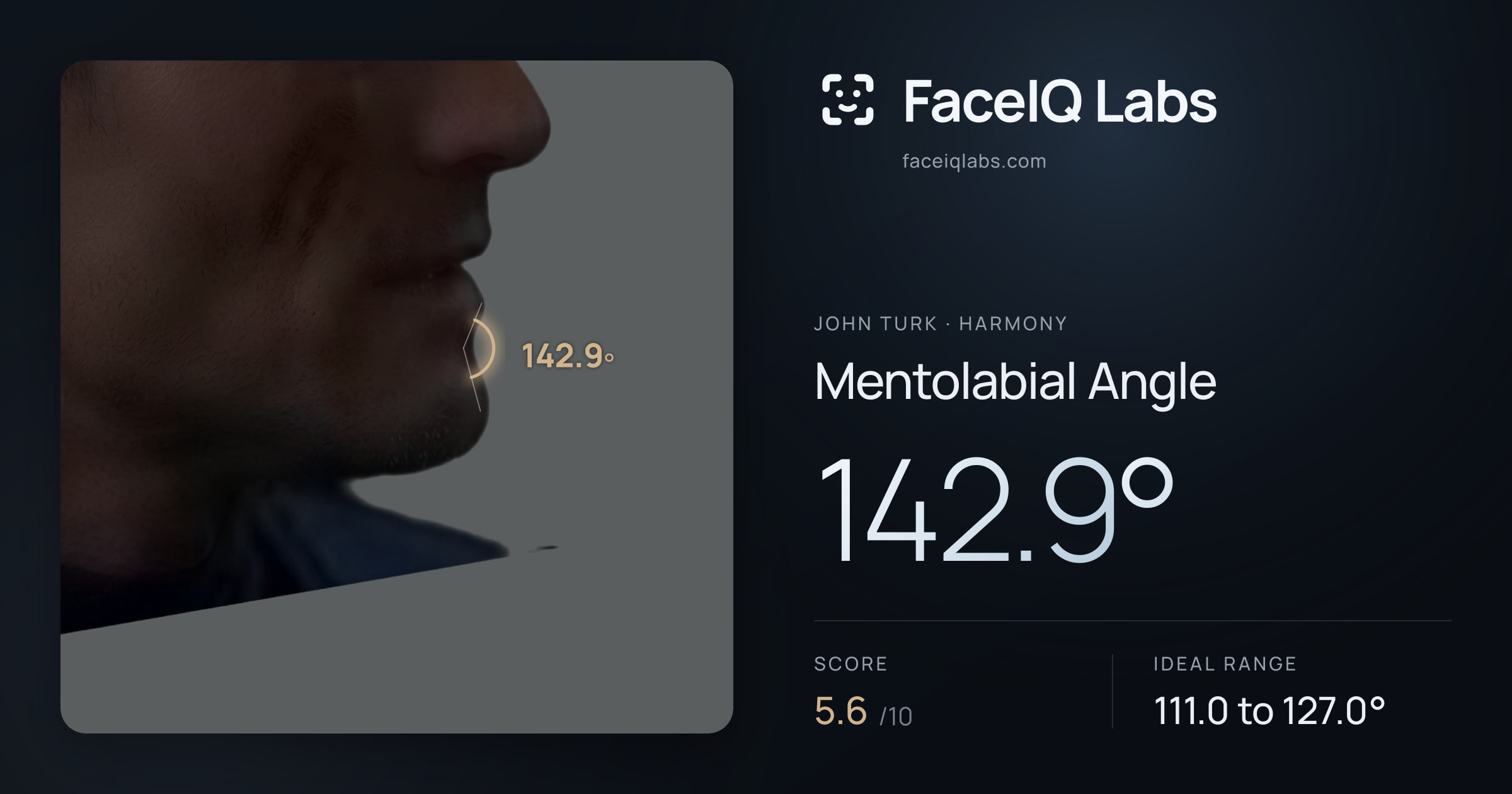 John Turk Mentolabial Angle: 142.9°, drawn on the photo