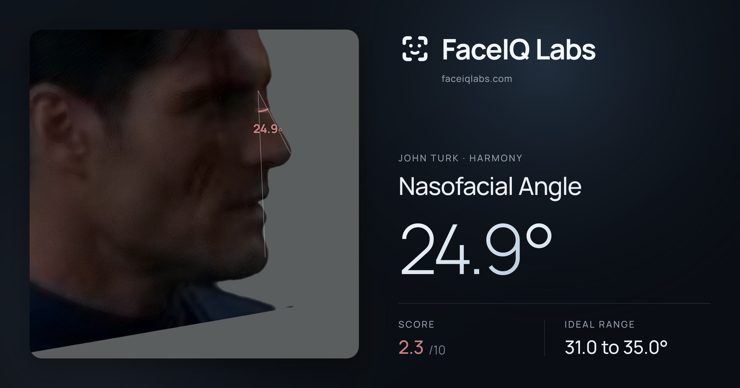 John Turk Nasofacial Angle: 24.9°, drawn on the photo