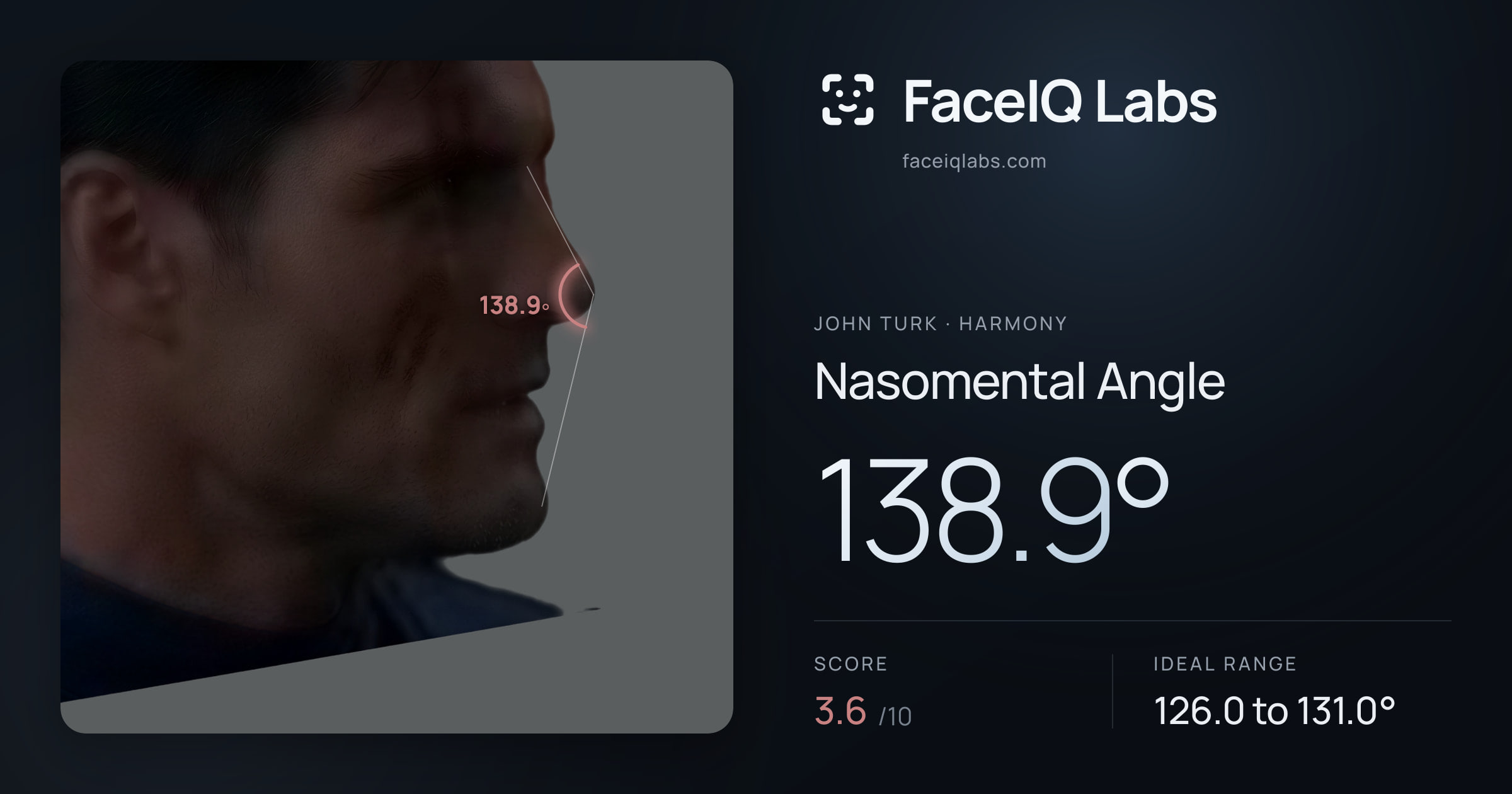 John Turk Nasomental Angle: 138.9°, drawn on the photo