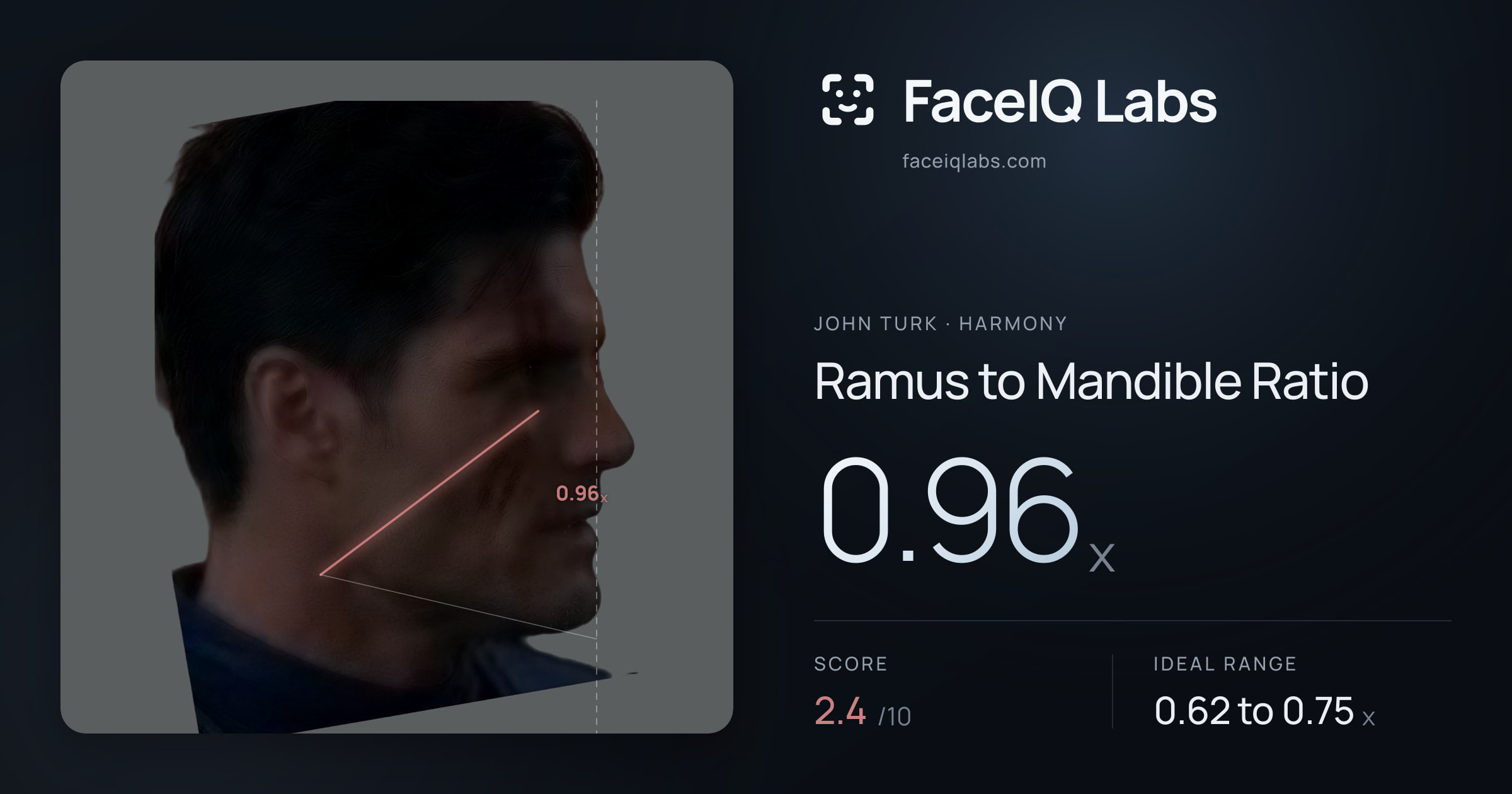 John Turk Ramus to Mandible Ratio: 0.96x, drawn on the photo