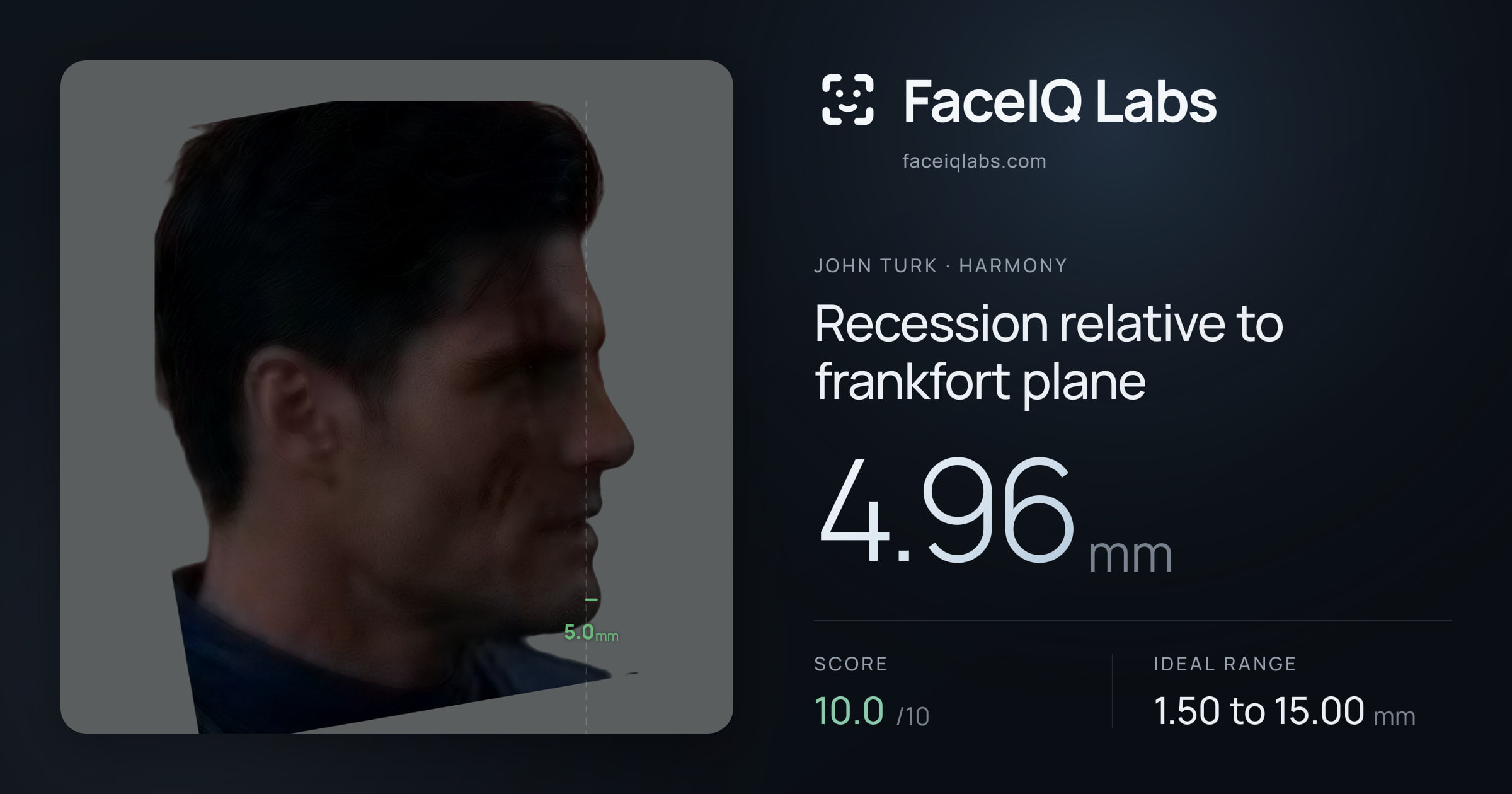 John Turk Recession relative to frankfort plane: 4.96mm, drawn on the photo