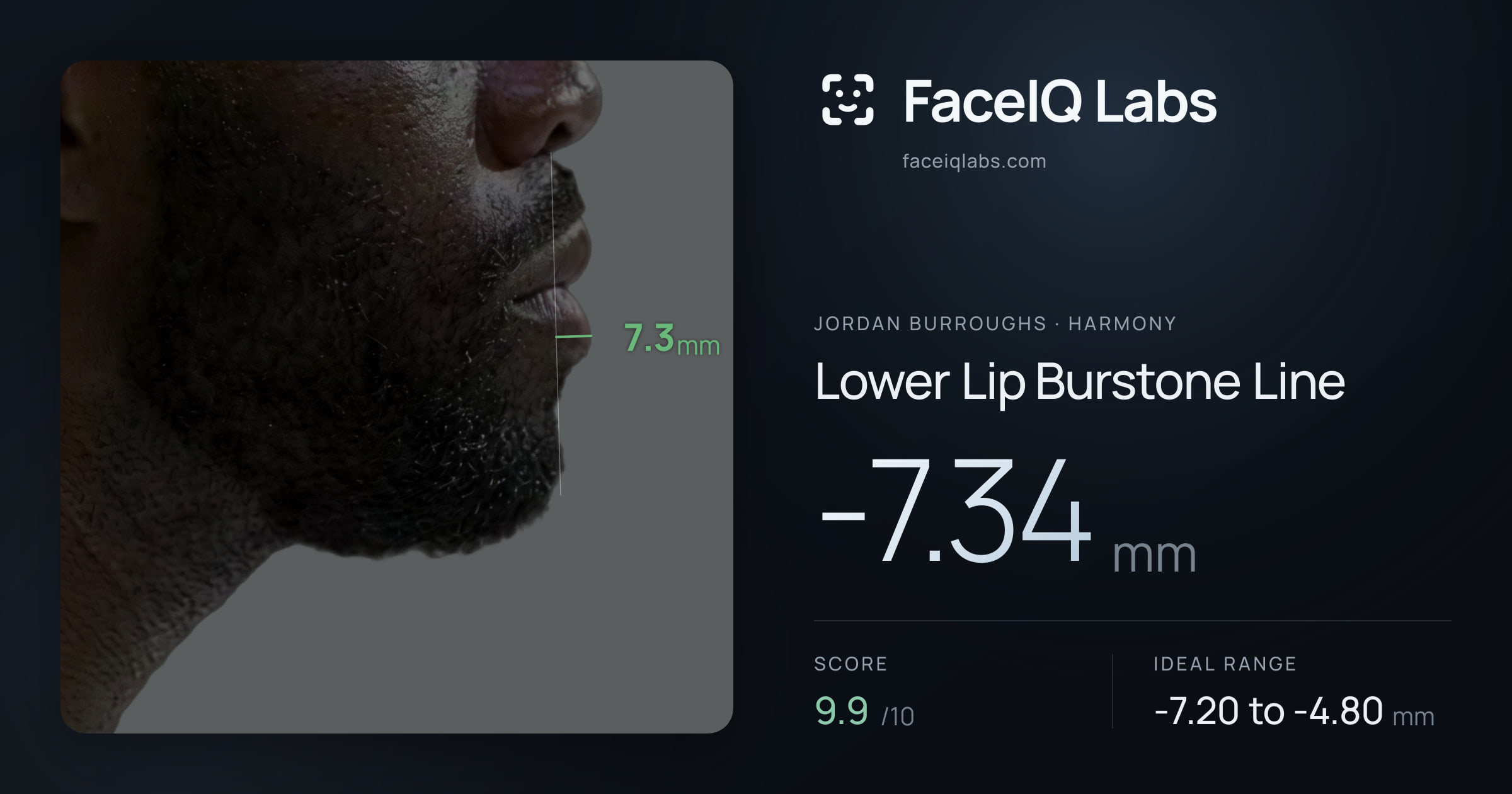 Jordan Burroughs Lower Lip Burstone Line: -7.34mm, drawn on the photo