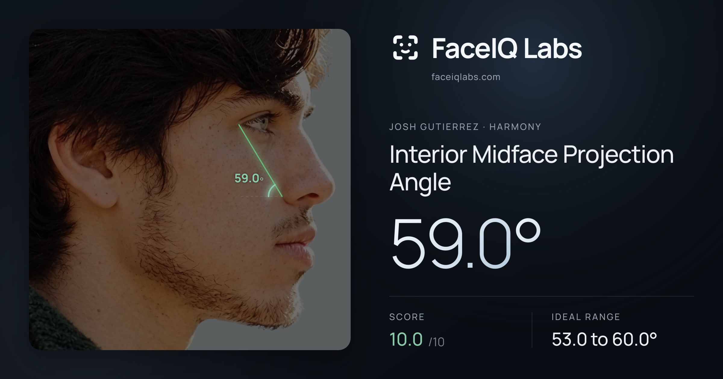 Josh Gutierrez Interior Midface Projection Angle: 59.0°, drawn on the photo