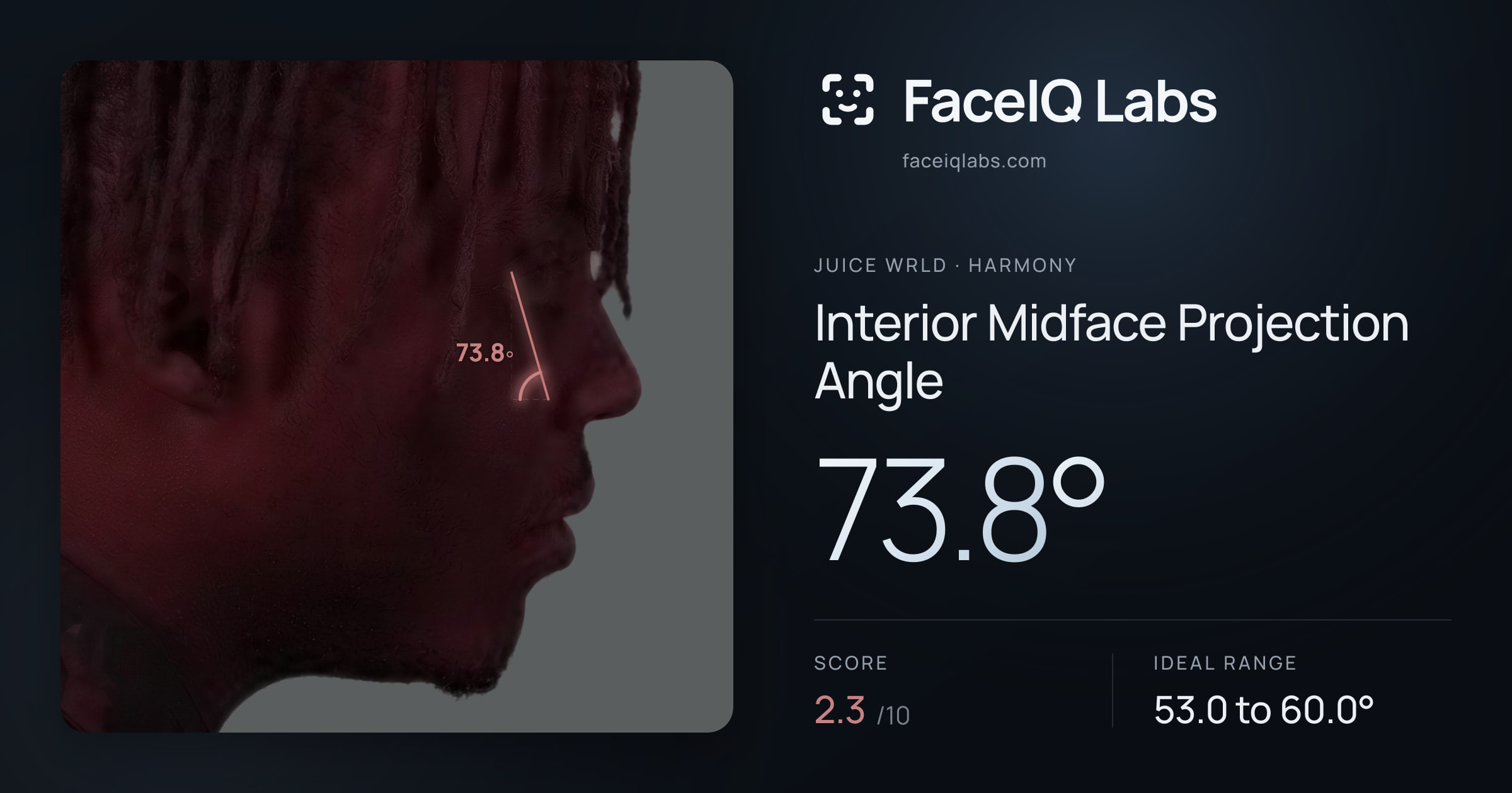 Juice WRLD Interior Midface Projection Angle: 73.8°, drawn on the photo