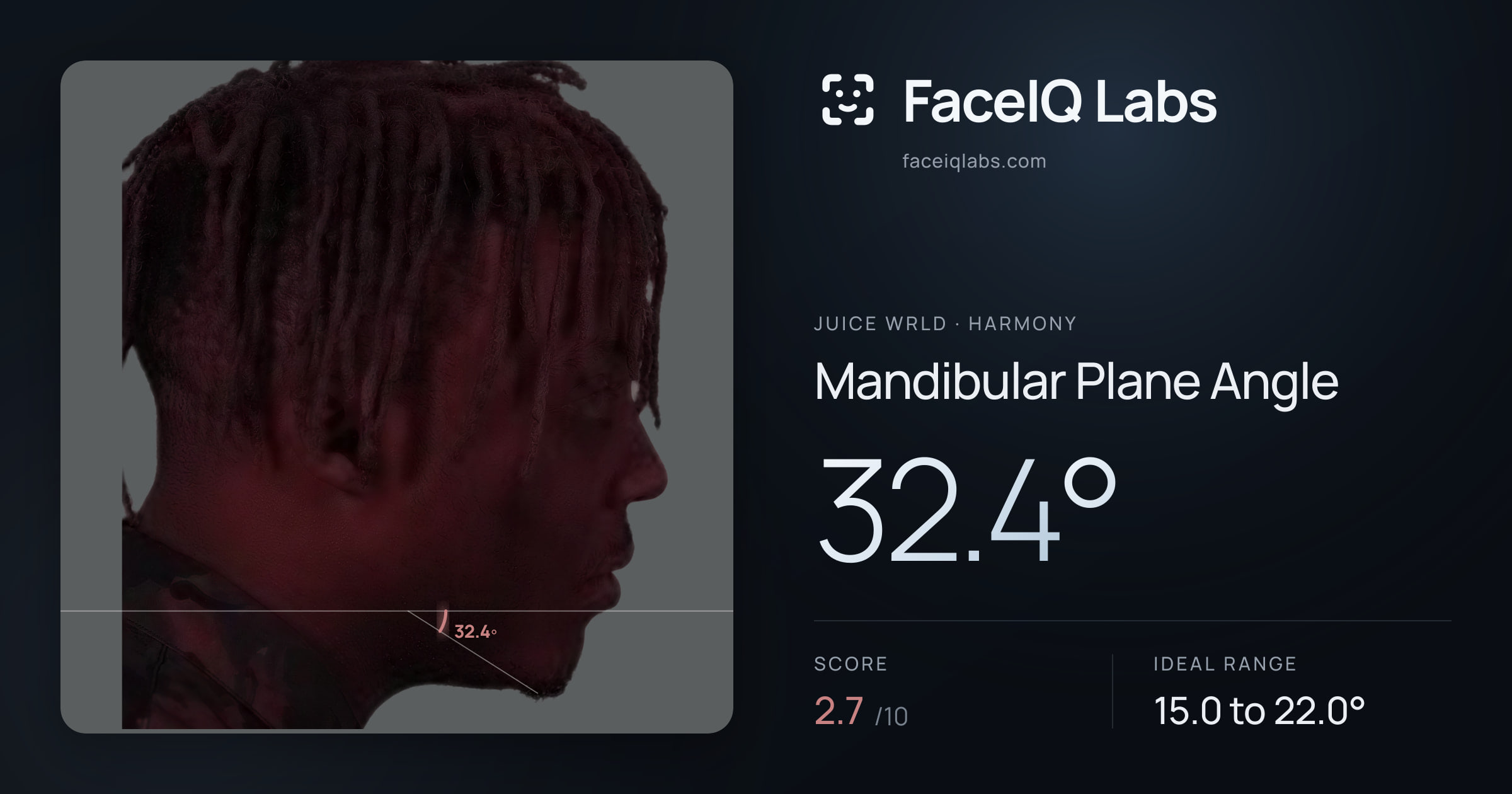 Juice WRLD Mandibular Plane Angle: 32.4°, drawn on the photo