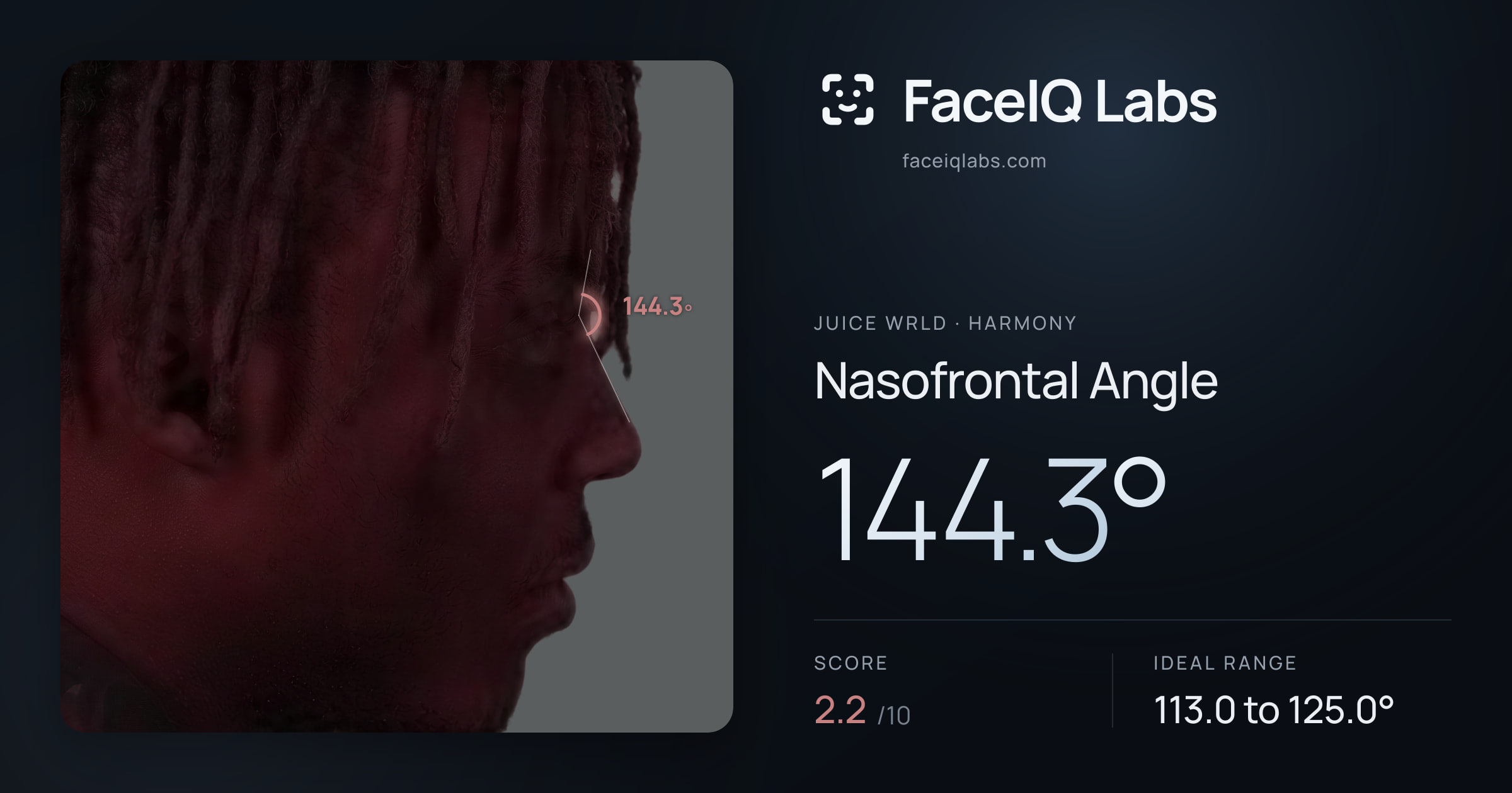 Juice WRLD Nasofrontal Angle: 144.3°, drawn on the photo