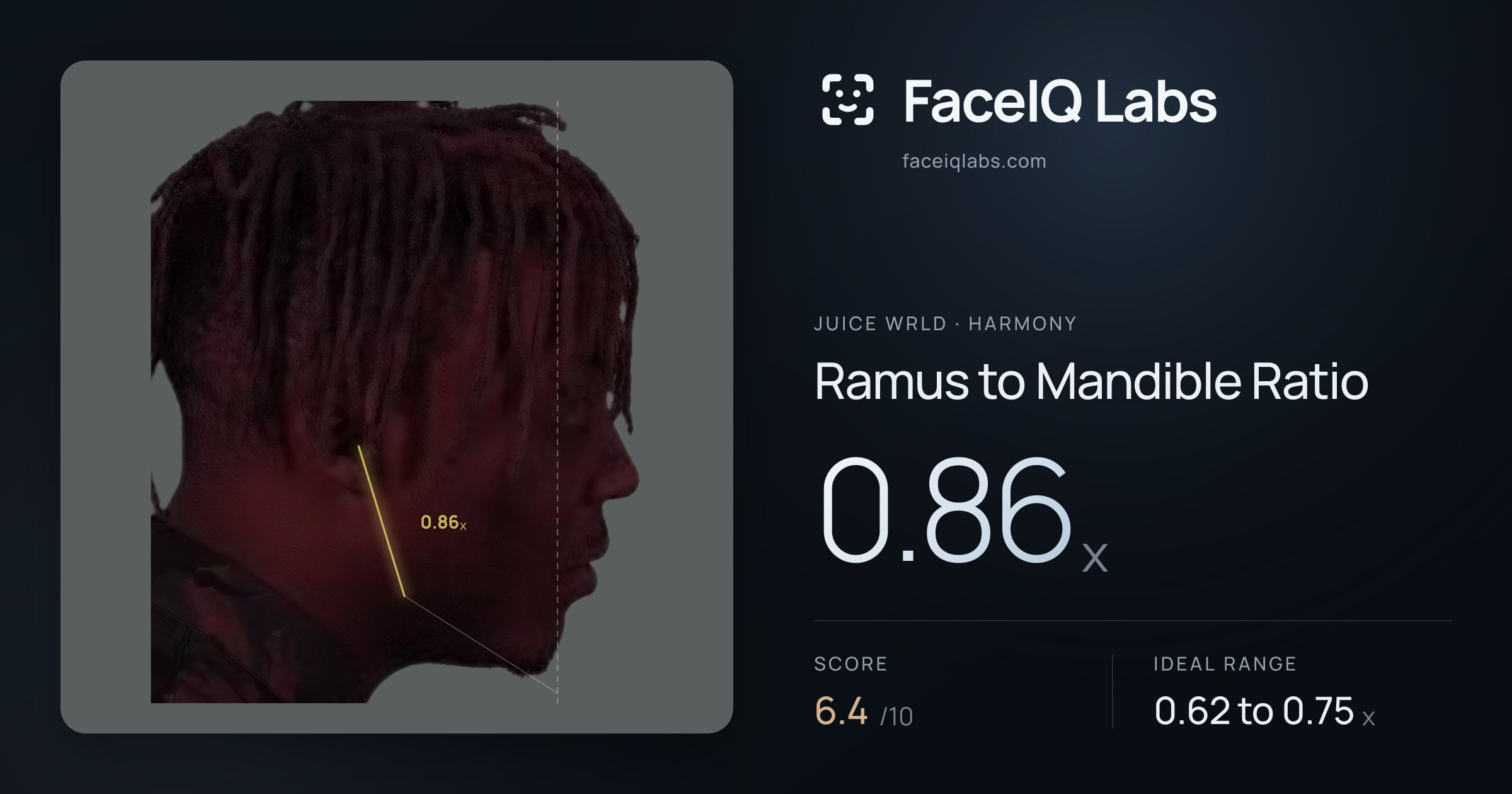Juice WRLD Ramus to Mandible Ratio: 0.86x, drawn on the photo