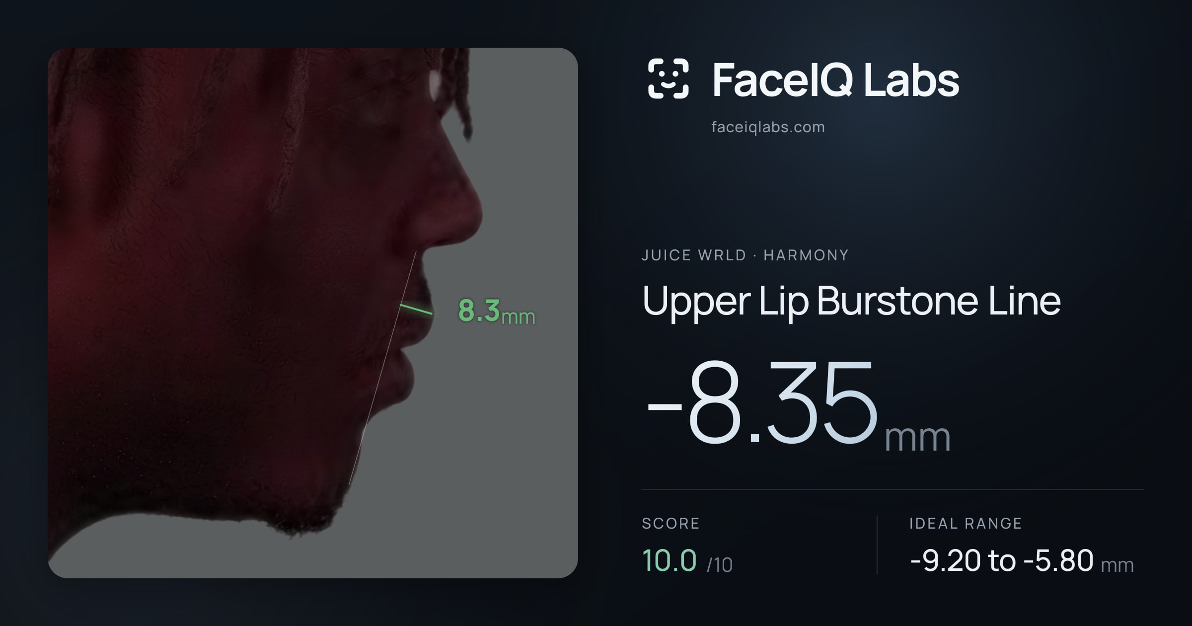 Juice WRLD Upper Lip Burstone Line: -8.35mm, drawn on the photo