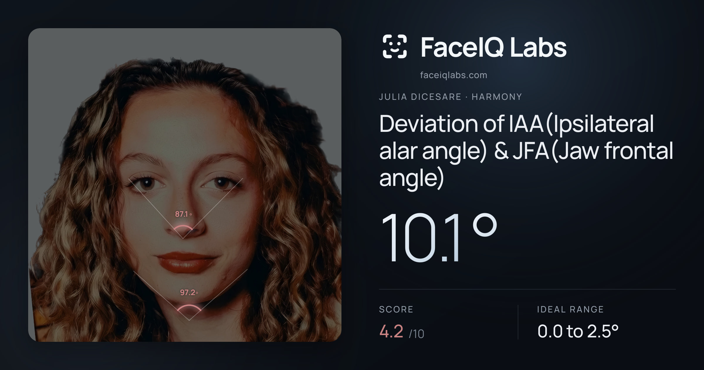 Julia DiCesare Deviation of IAA(Ipsilateral alar angle) & JFA(Jaw frontal angle): 10.1°, drawn on the photo