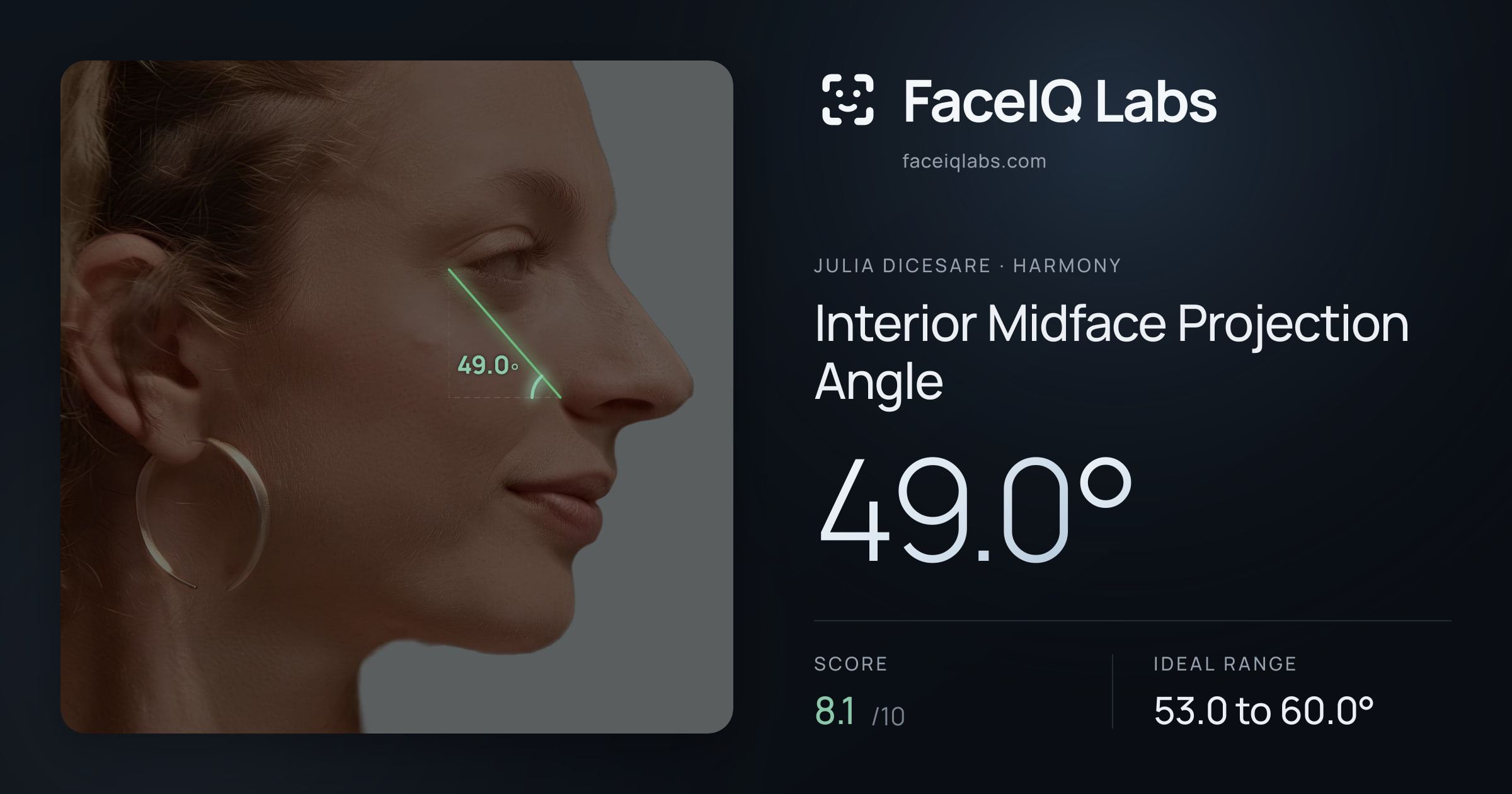 Julia DiCesare Interior Midface Projection Angle: 49.0°, drawn on the photo