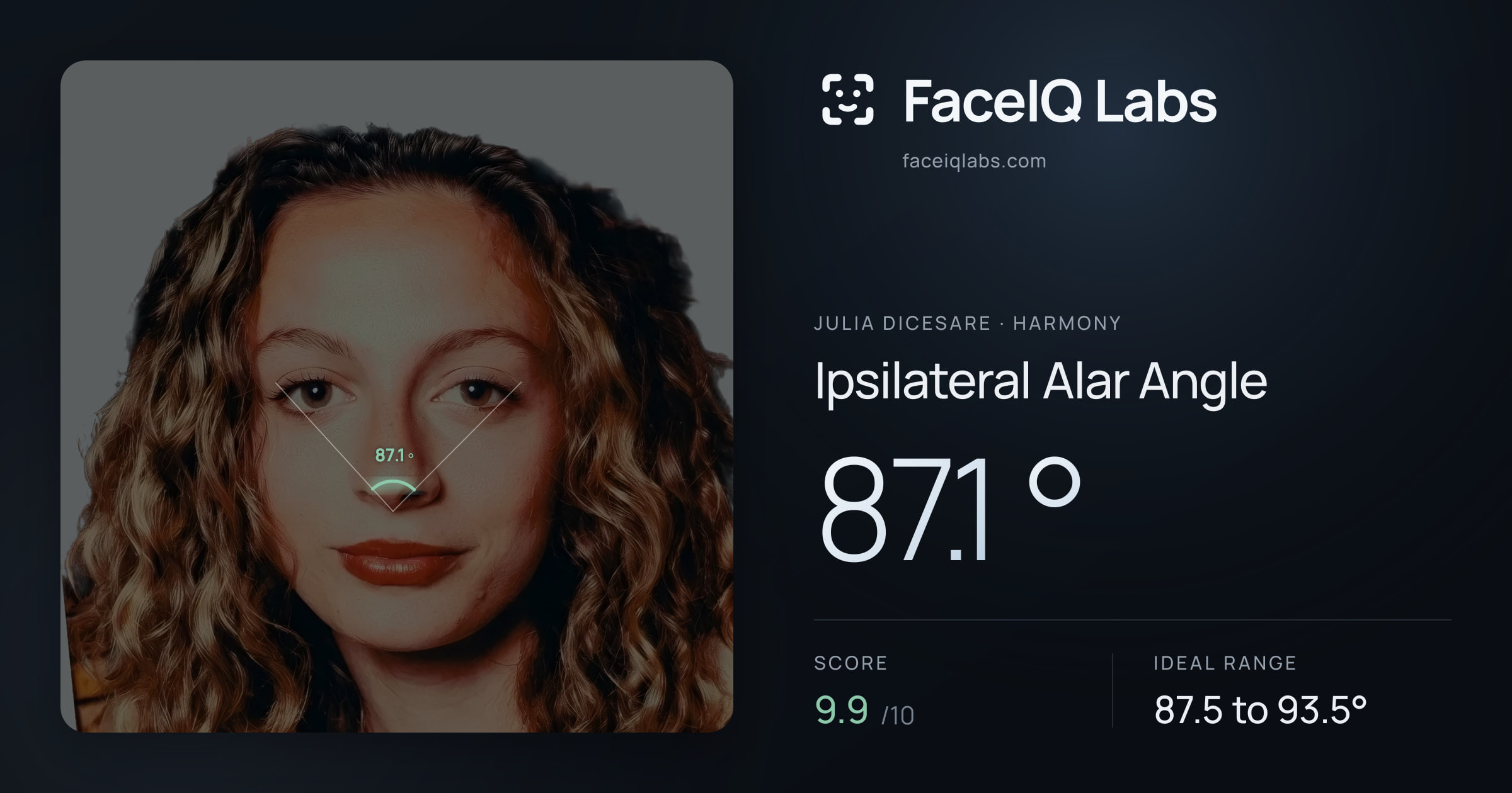 Julia DiCesare Ipsilateral Alar Angle: 87.1°, drawn on the photo