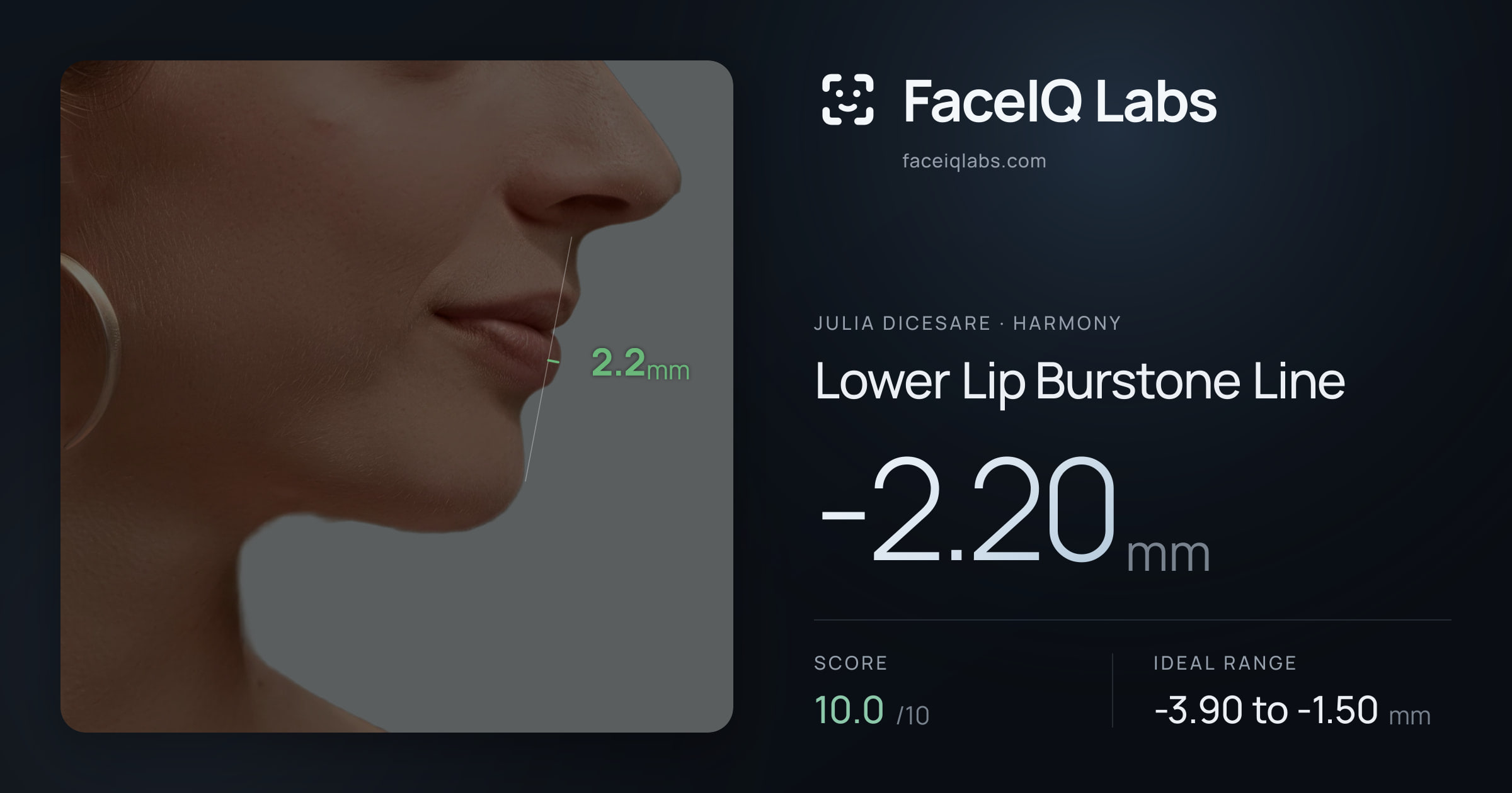 Julia DiCesare Lower Lip Burstone Line: -2.20mm, drawn on the photo