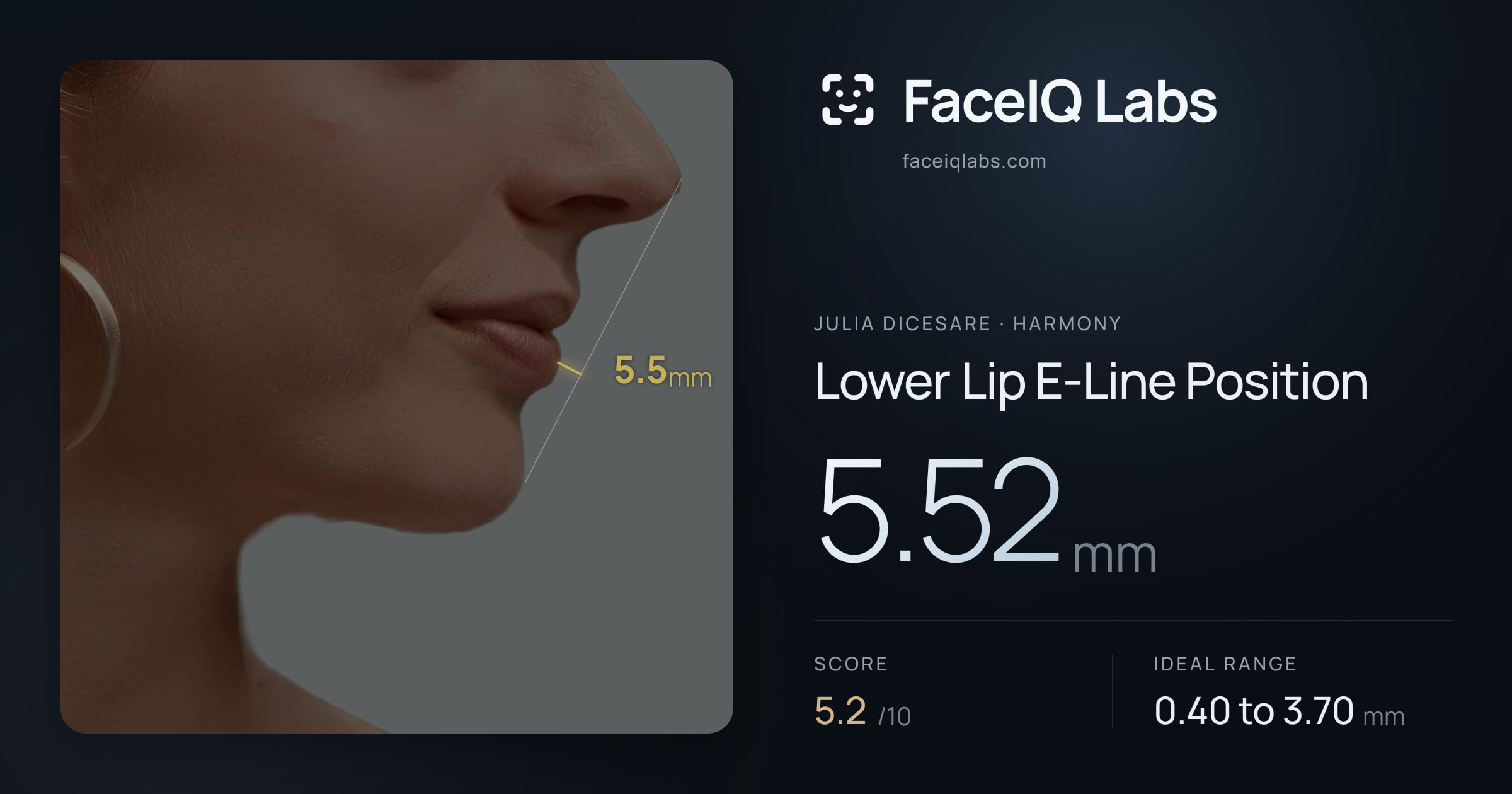 Julia DiCesare Lower Lip E-Line Position: 5.52mm, drawn on the photo