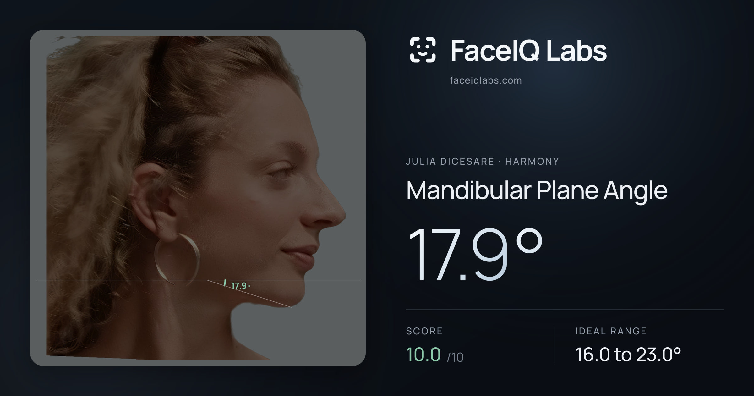 Julia DiCesare Mandibular Plane Angle: 17.9°, drawn on the photo