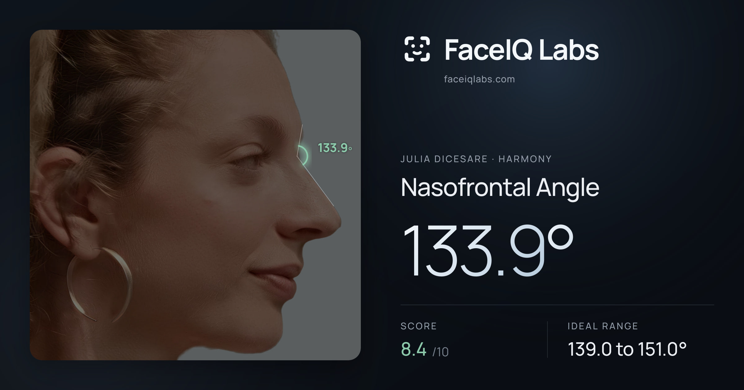 Julia DiCesare Nasofrontal Angle: 133.9°, drawn on the photo