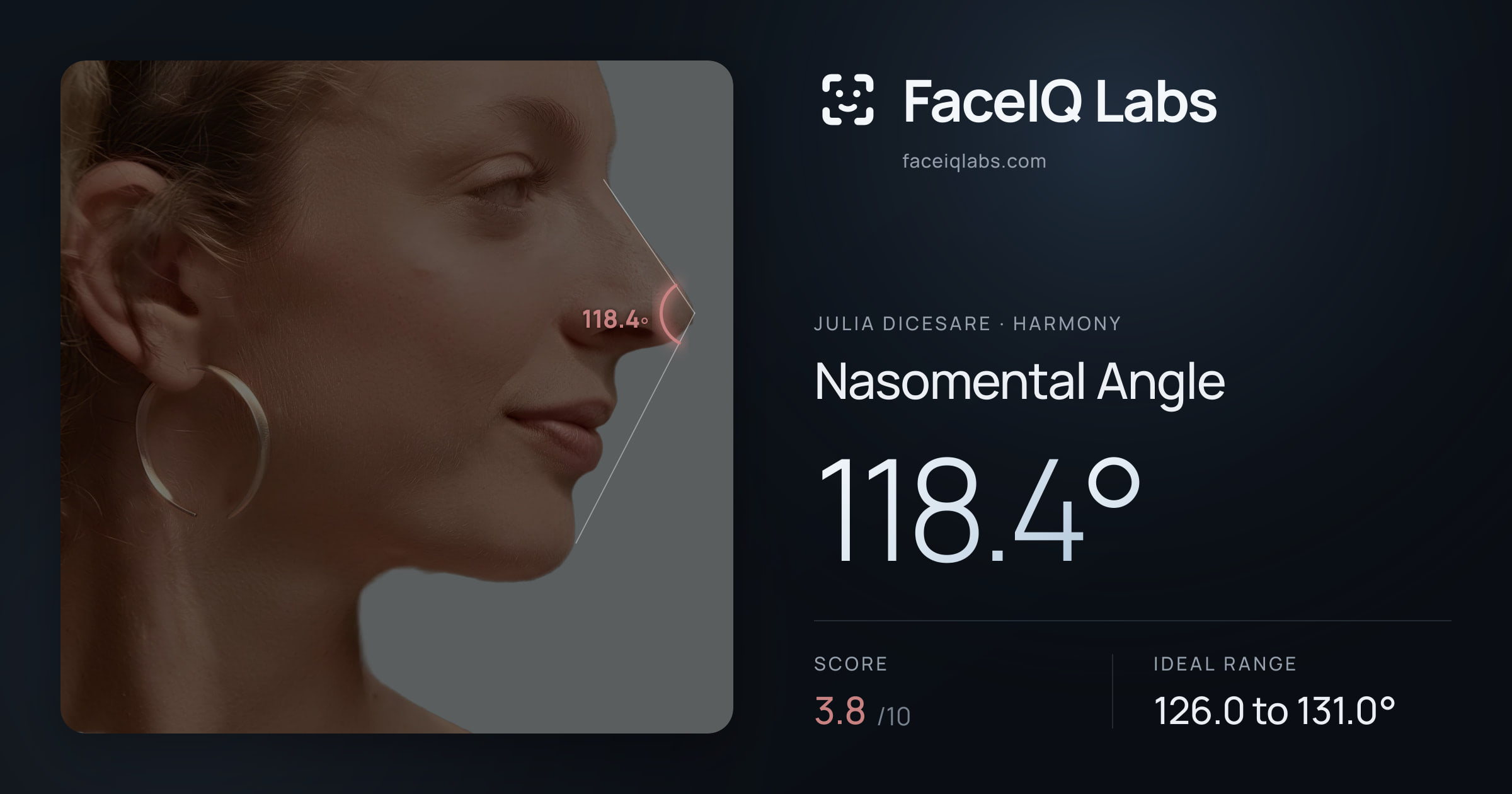 Julia DiCesare Nasomental Angle: 118.4°, drawn on the photo
