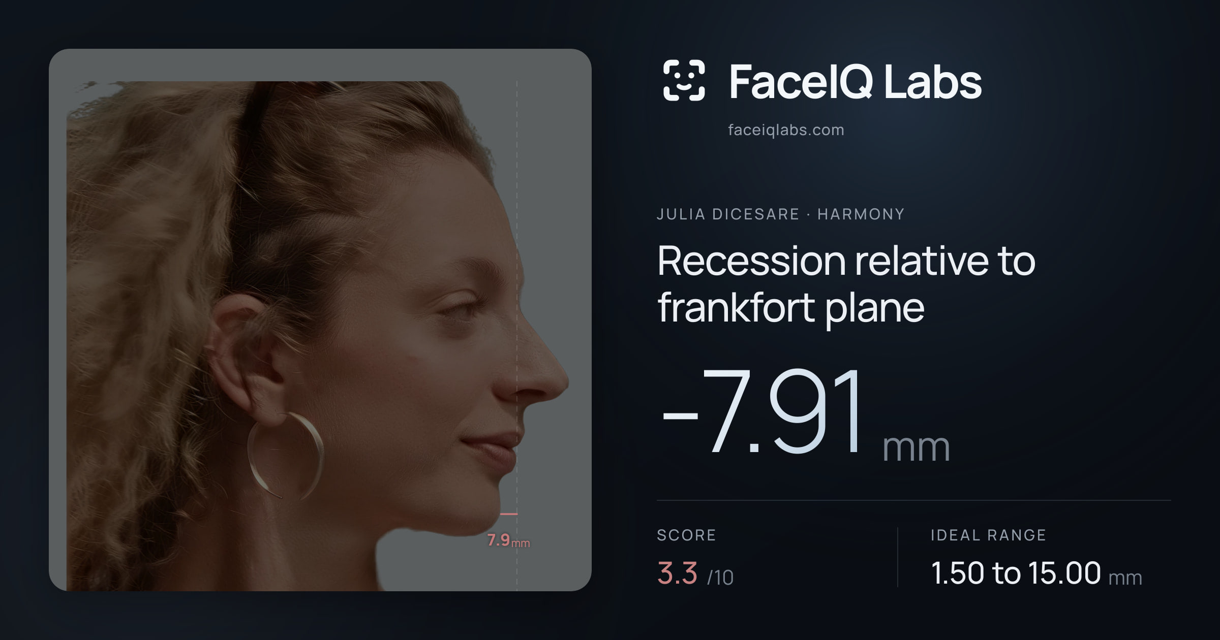 Julia DiCesare Recession relative to frankfort plane: -7.91mm, drawn on the photo