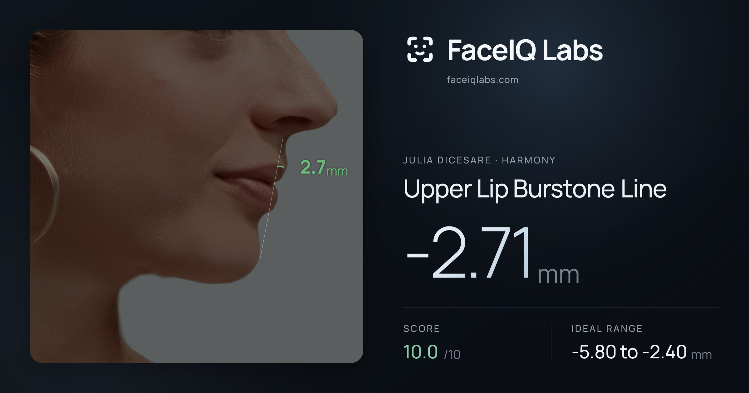 Julia DiCesare Upper Lip Burstone Line: -2.71mm, drawn on the photo