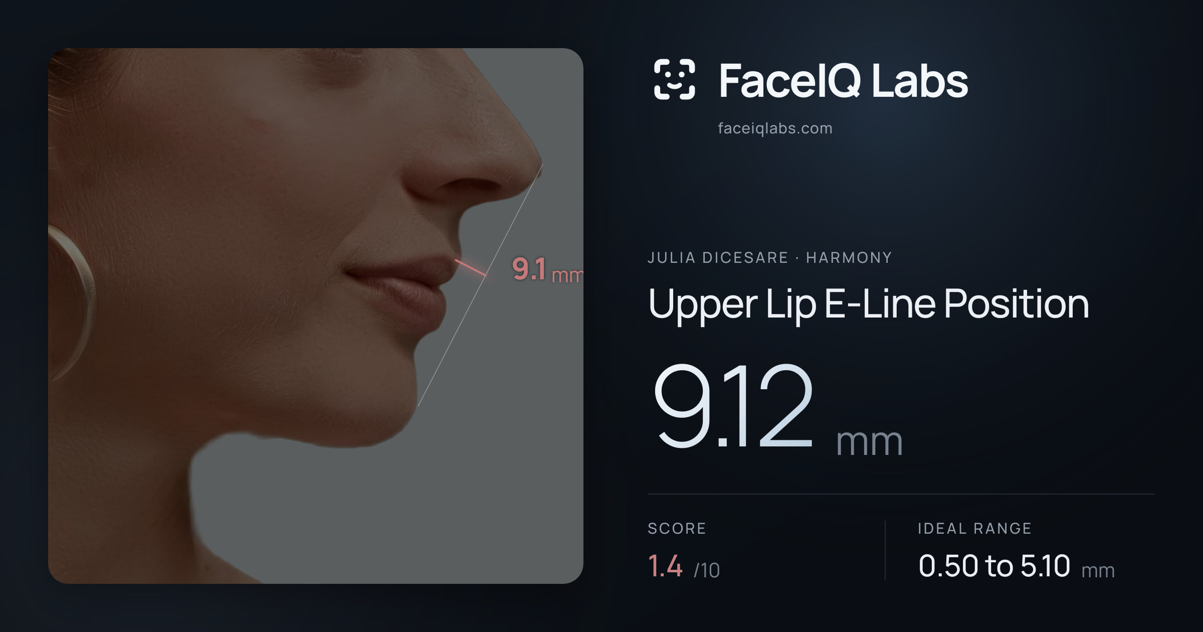 Julia DiCesare Upper Lip E-Line Position: 9.12mm, drawn on the photo