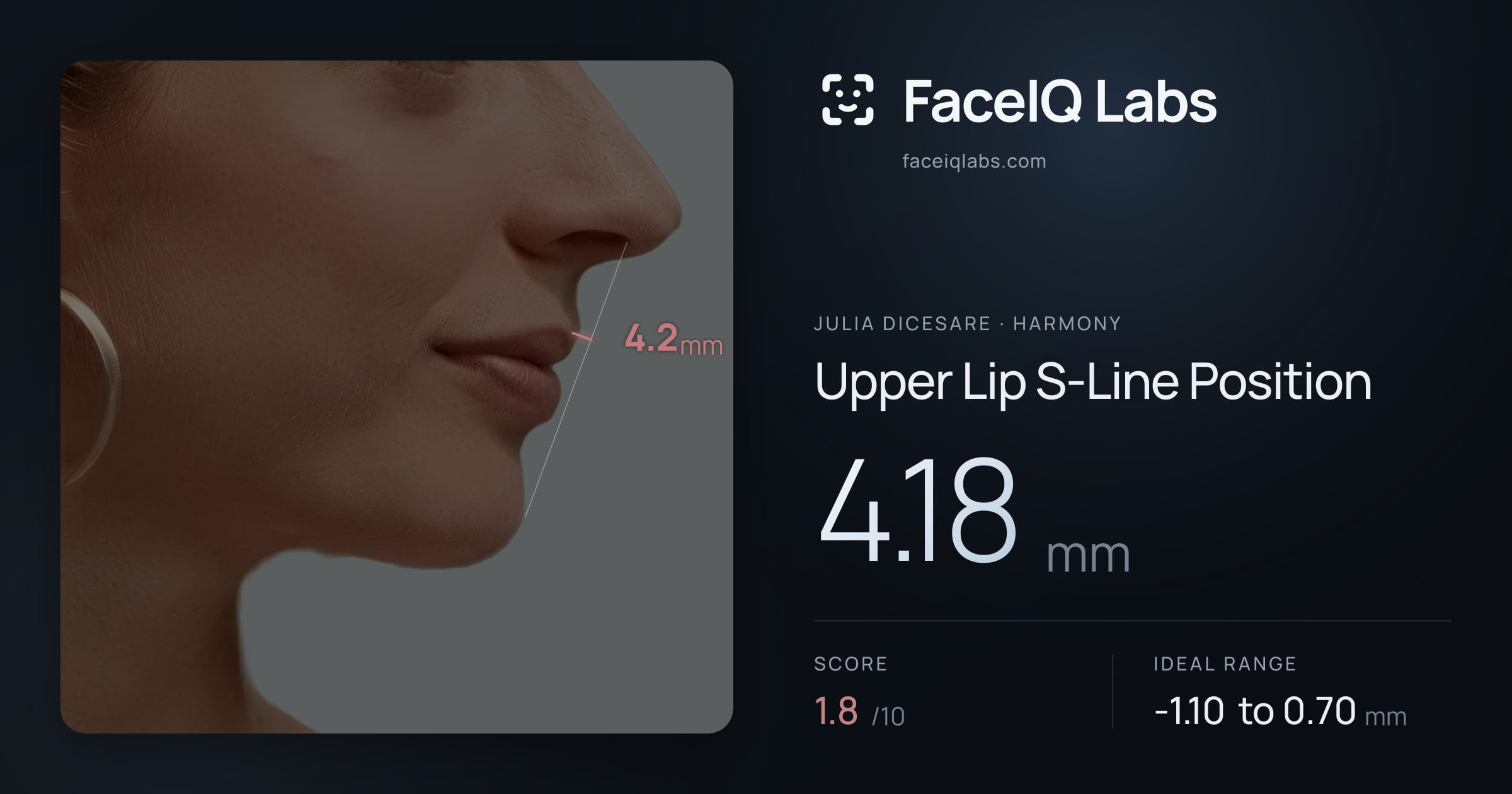 Julia DiCesare Upper Lip S-Line Position: 4.18mm, drawn on the photo
