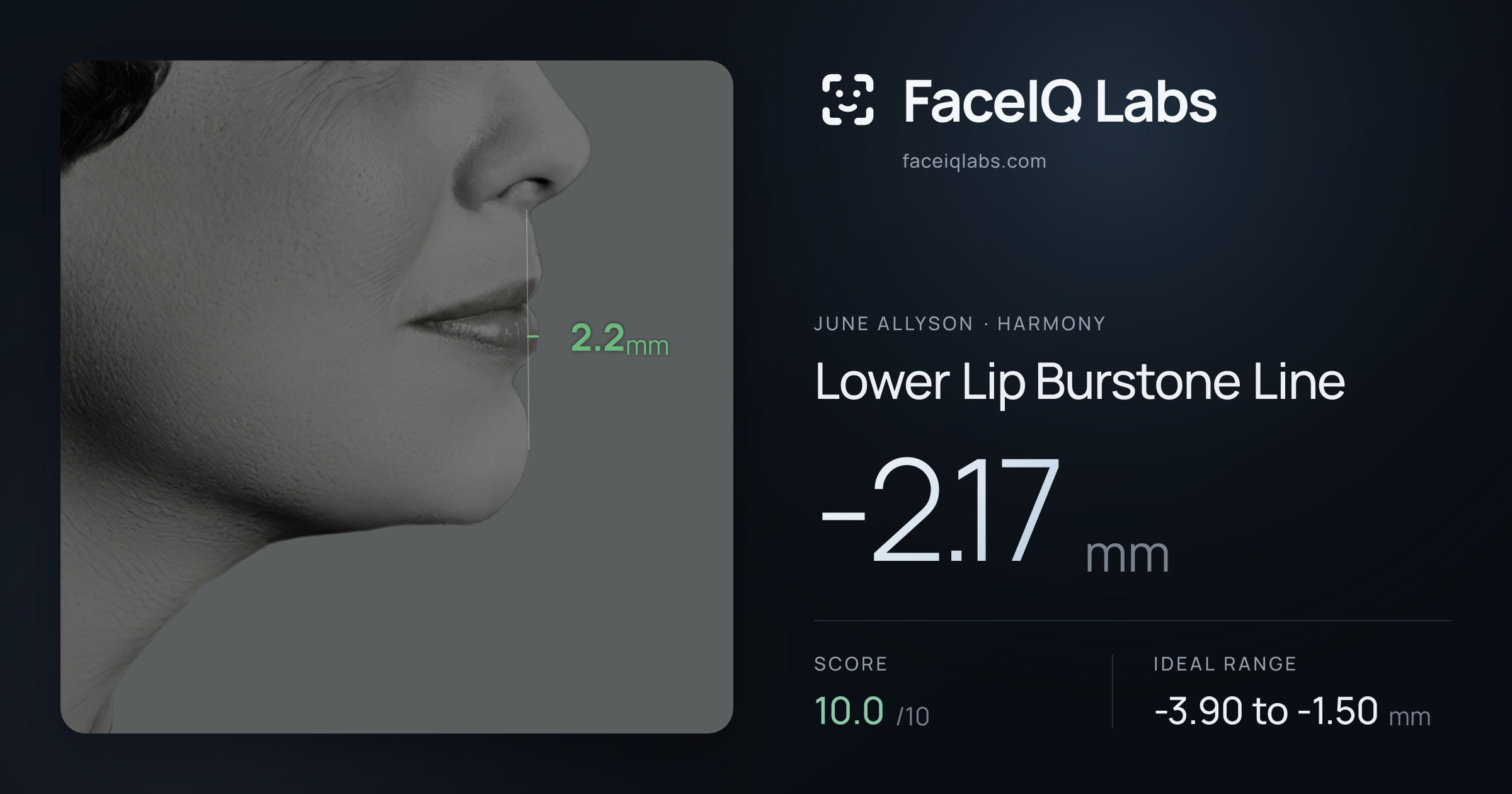 June Allyson Lower Lip Burstone Line: -2.17mm, drawn on the photo