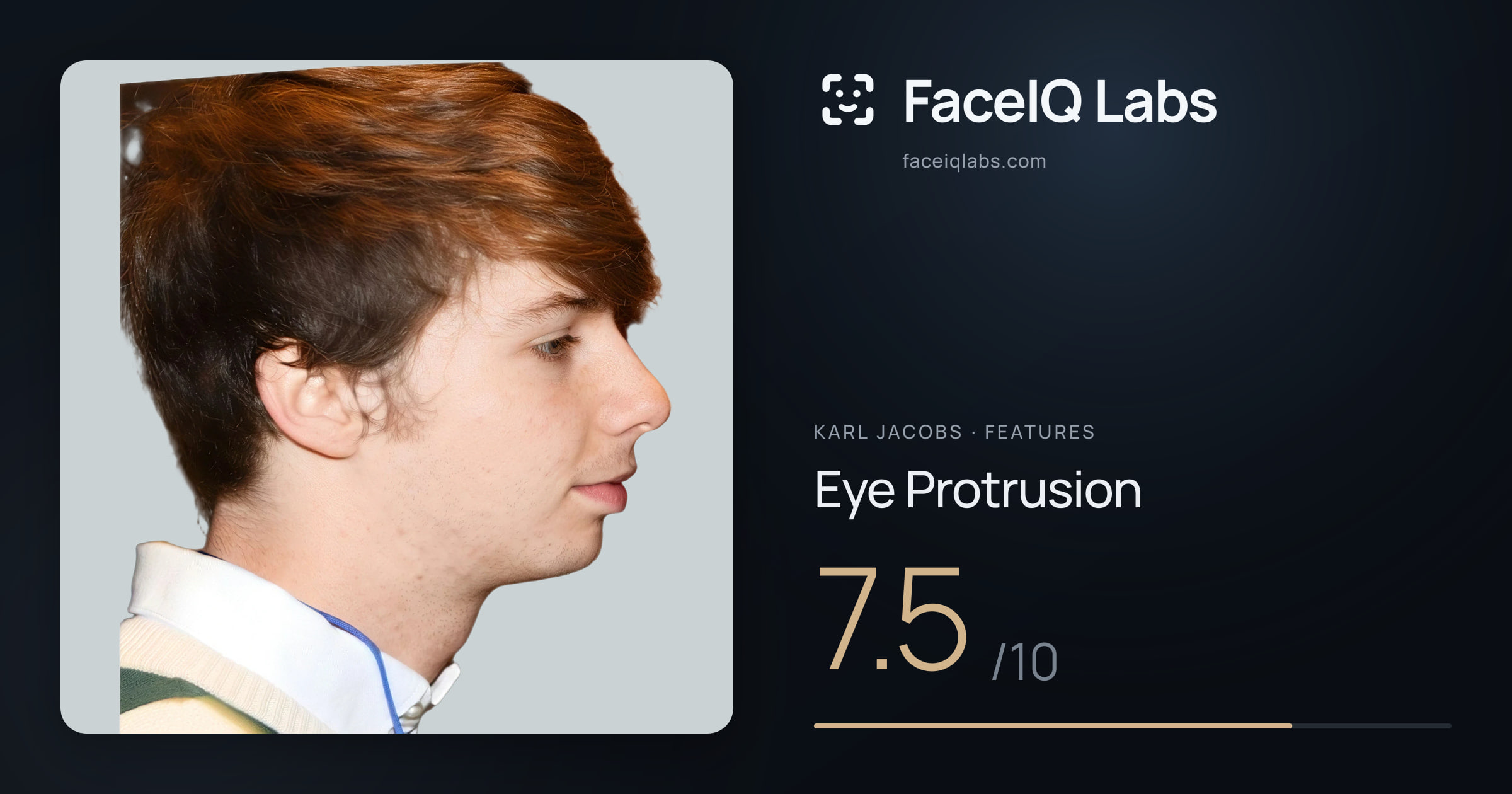 Karl Jacobs Eye Protrusion: 7.5/10, drawn on the photo