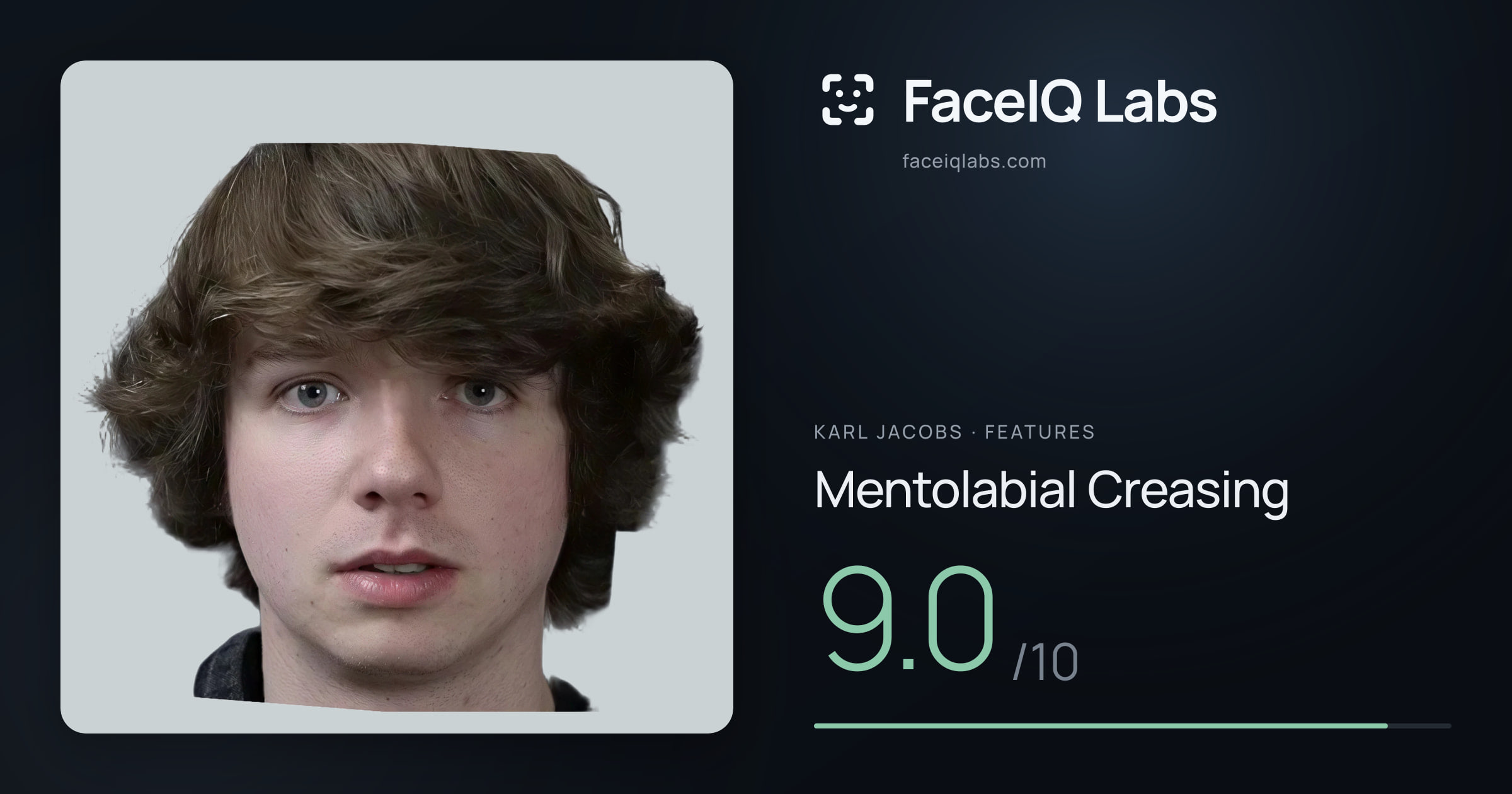 Karl Jacobs Mentolabial Creasing: 9.0/10, drawn on the photo