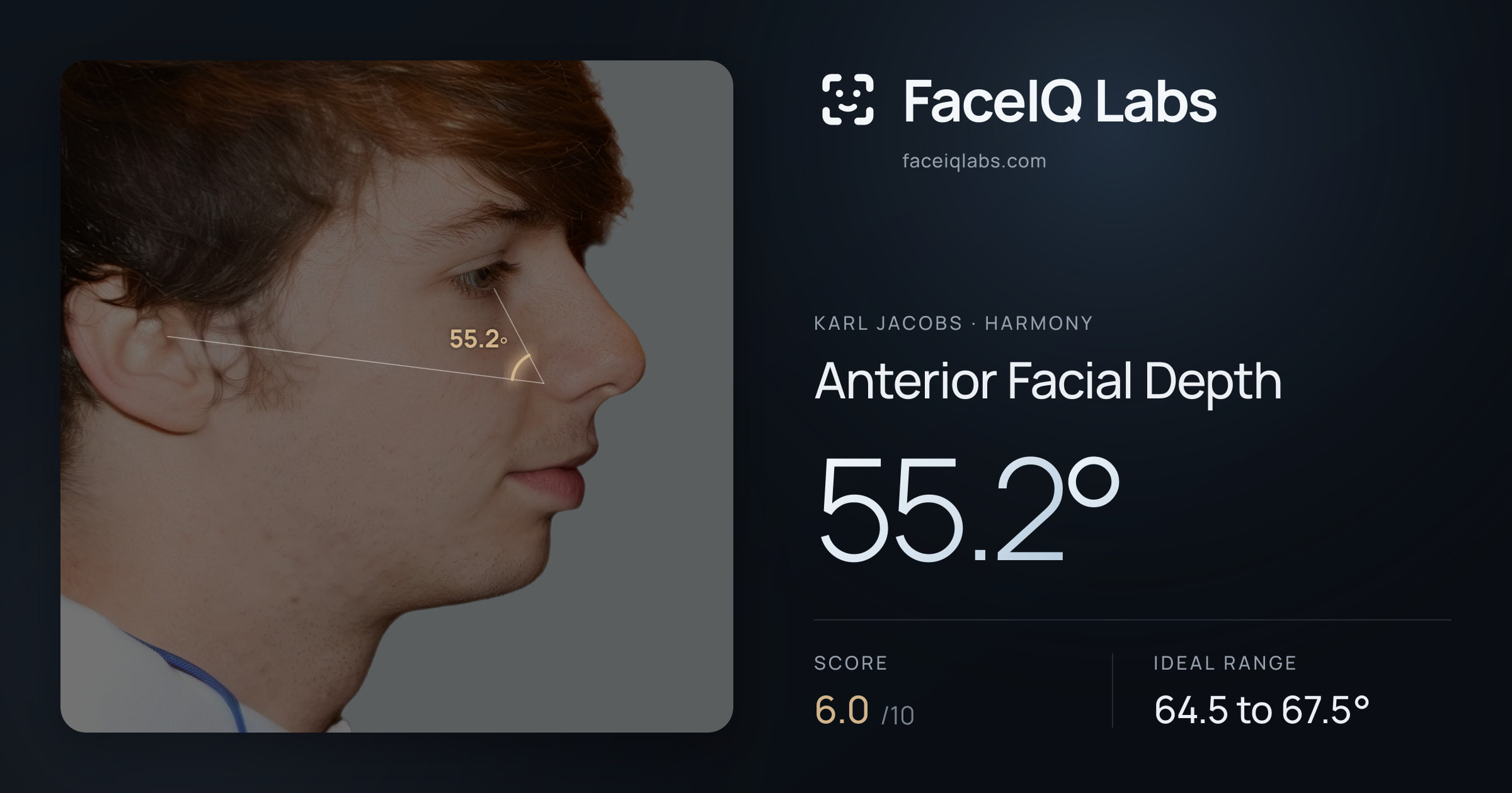 Karl Jacobs Anterior Facial Depth: 55.2°, drawn on the photo