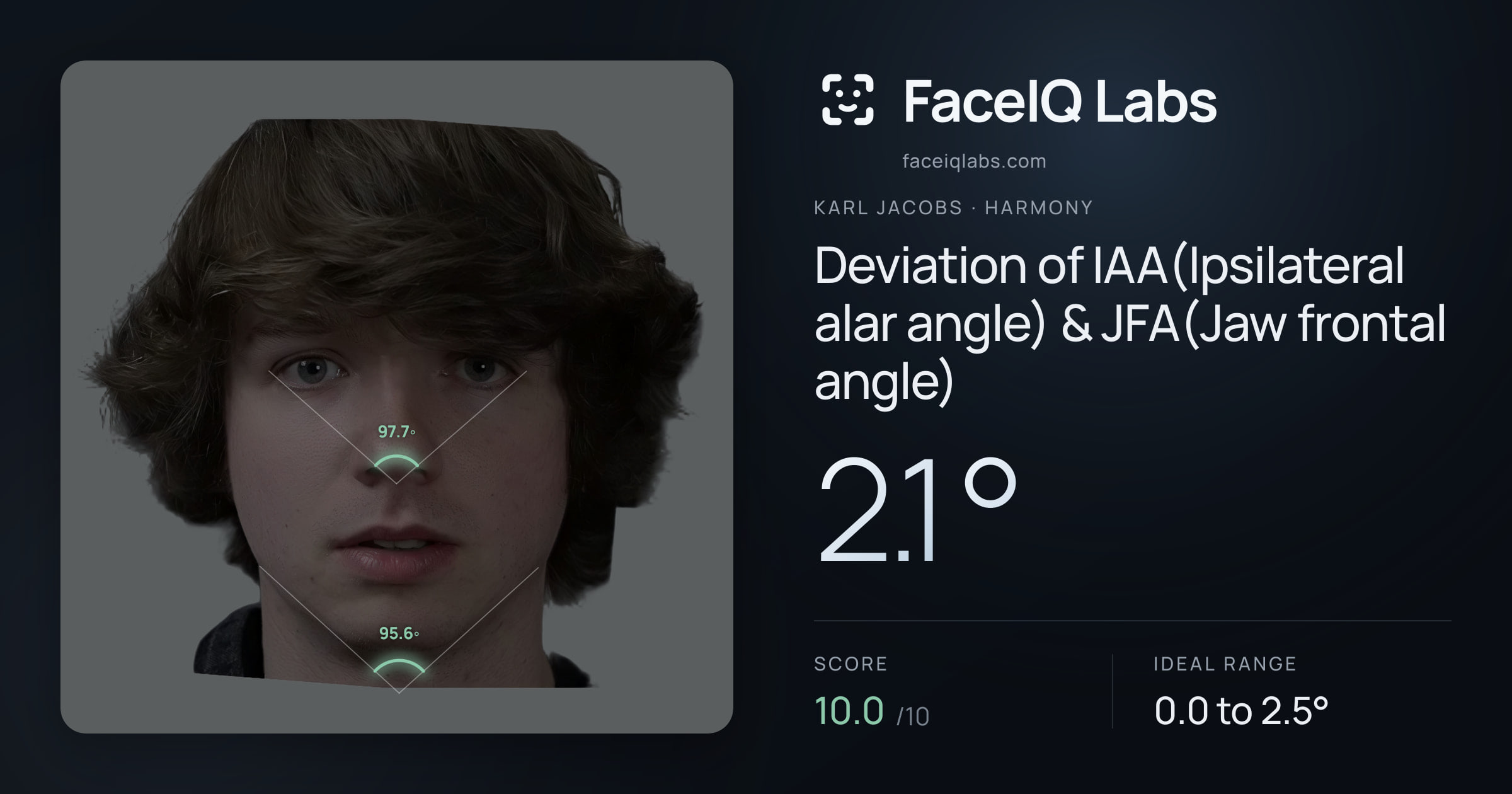 Karl Jacobs Deviation of IAA(Ipsilateral alar angle) & JFA(Jaw frontal angle): 2.1°, drawn on the photo