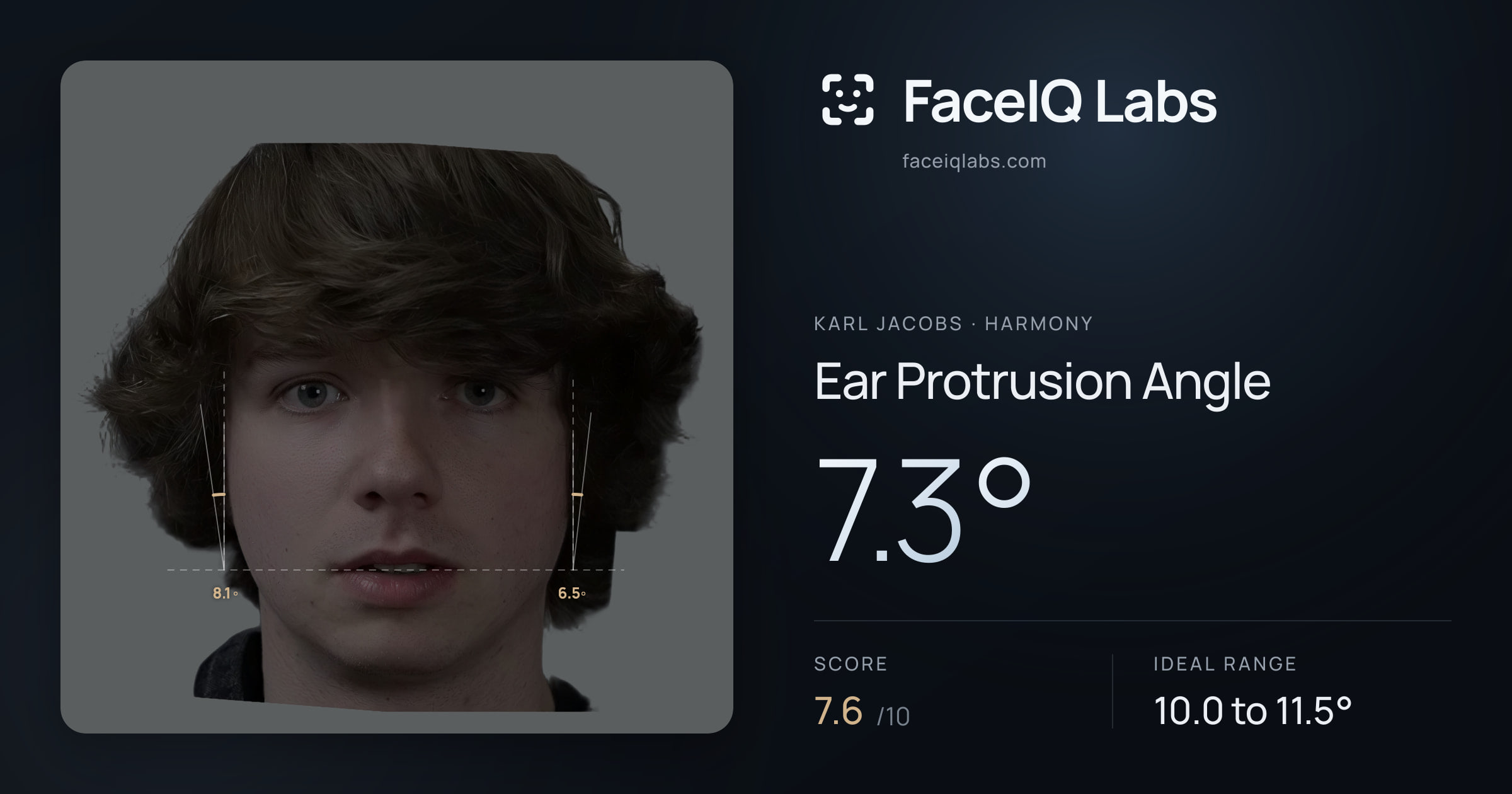 Karl Jacobs Ear Protrusion Angle: 7.3°, drawn on the photo
