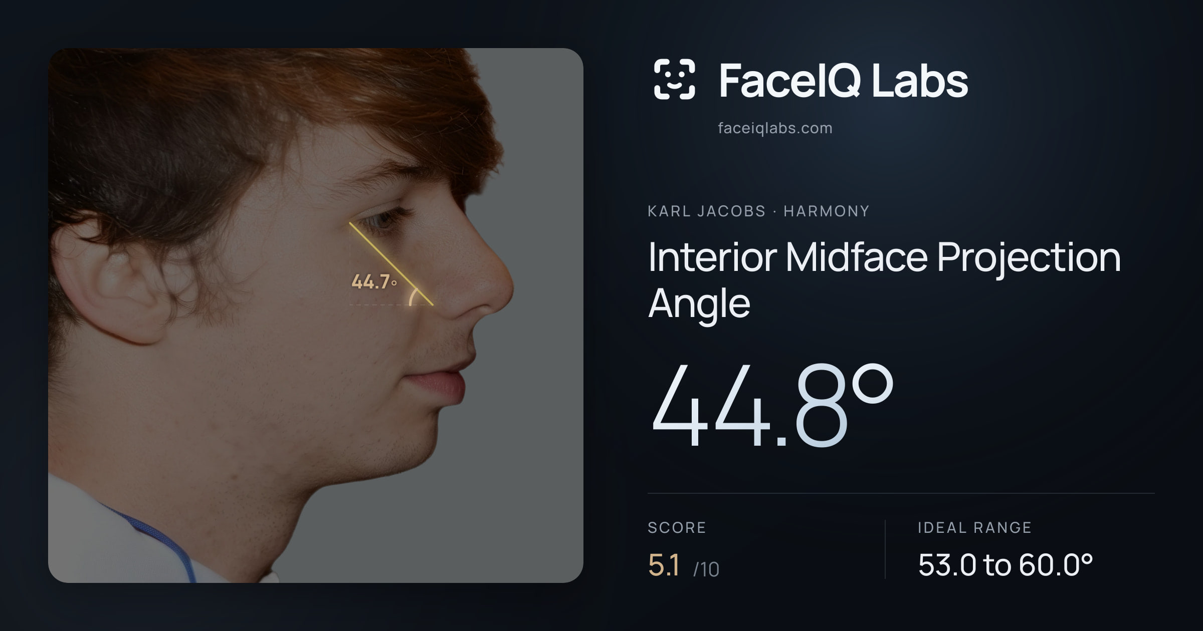 Karl Jacobs Interior Midface Projection Angle: 44.8°, drawn on the photo