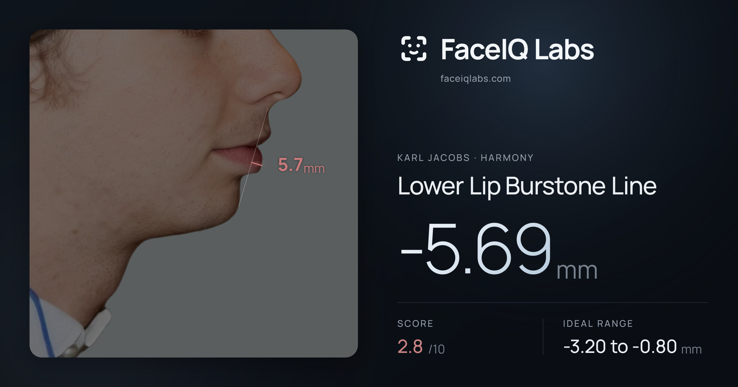 Karl Jacobs Lower Lip Burstone Line: -5.69mm, drawn on the photo