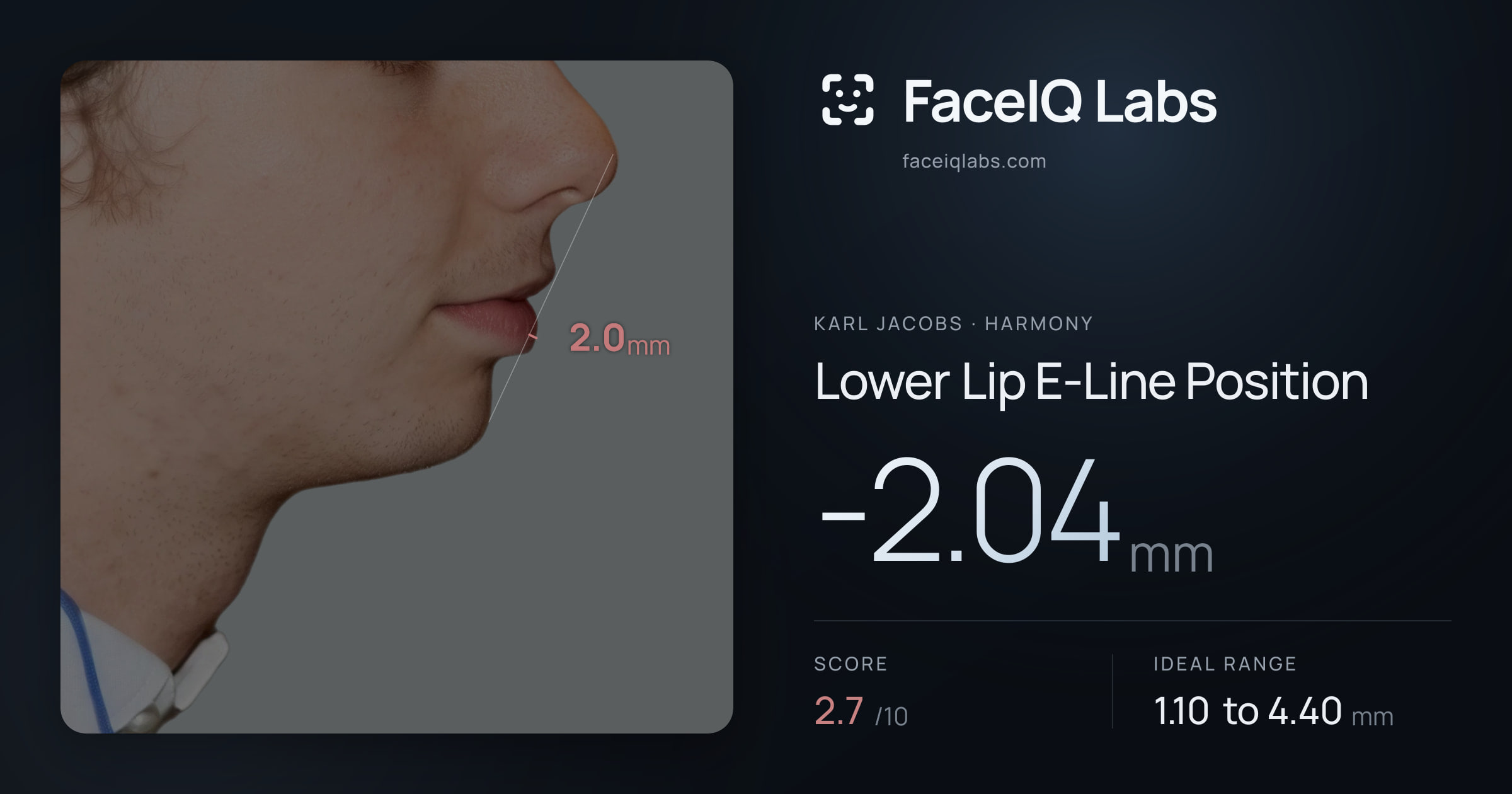 Karl Jacobs Lower Lip E-Line Position: -2.04mm, drawn on the photo