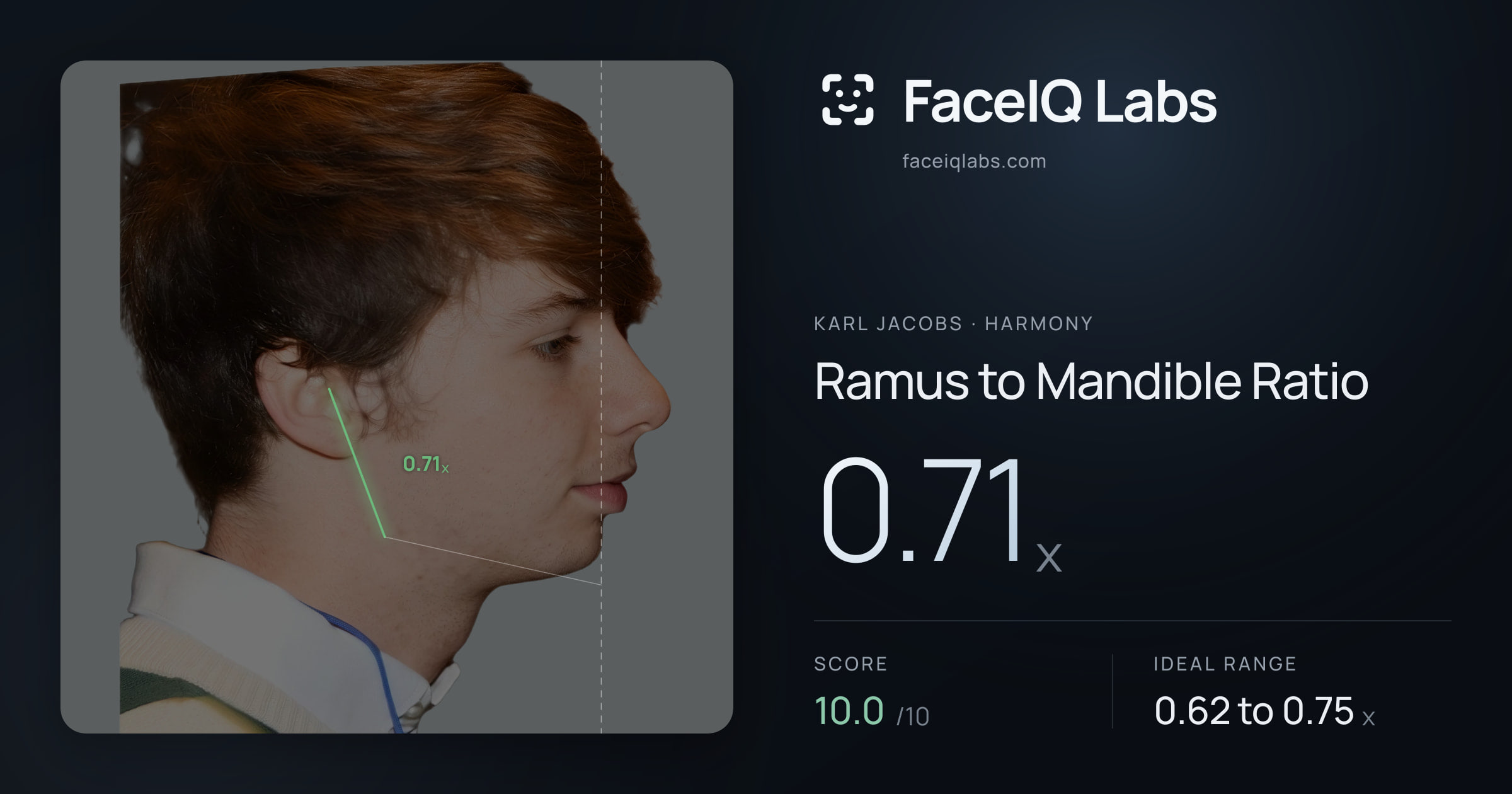 Karl Jacobs Ramus to Mandible Ratio: 0.71x, drawn on the photo