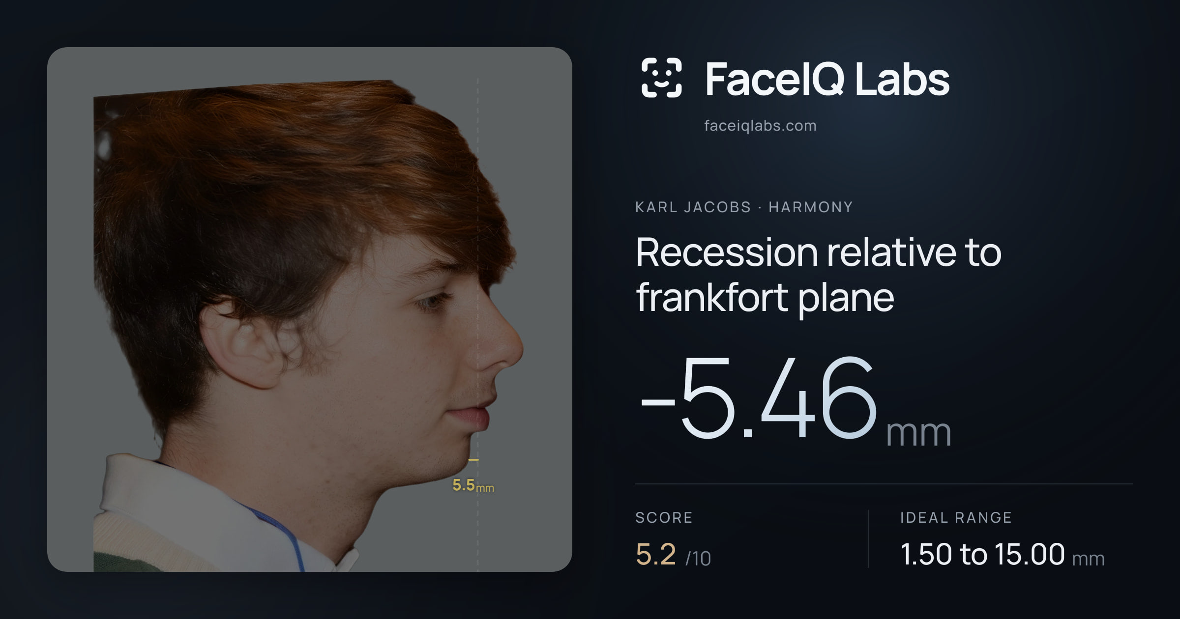 Karl Jacobs Recession relative to frankfort plane: -5.46mm, drawn on the photo