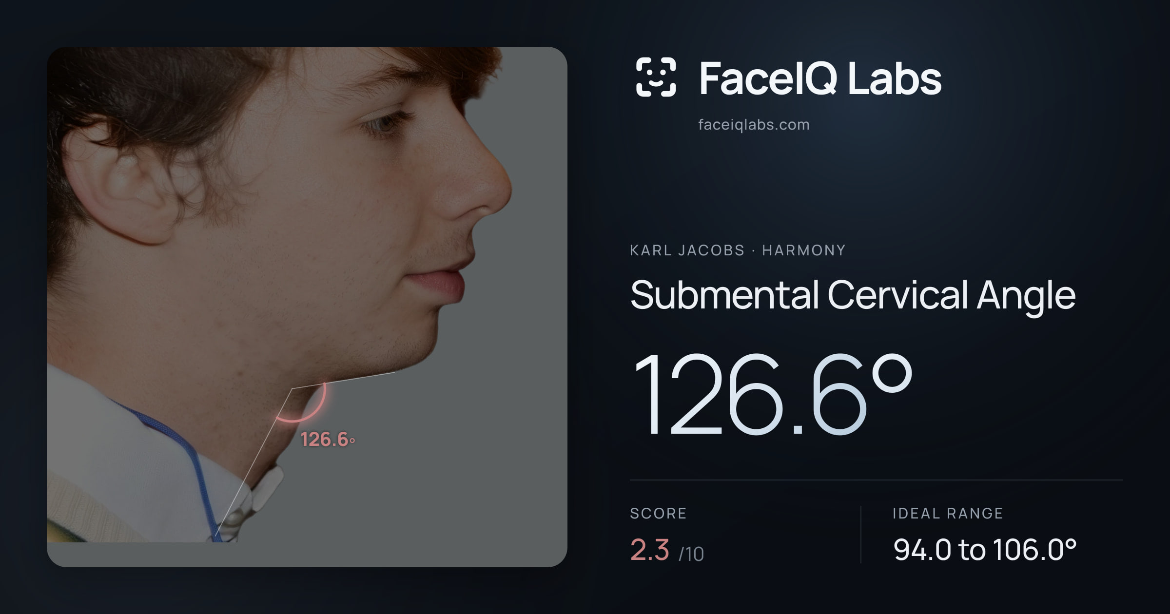 Karl Jacobs Submental Cervical Angle: 126.6°, drawn on the photo