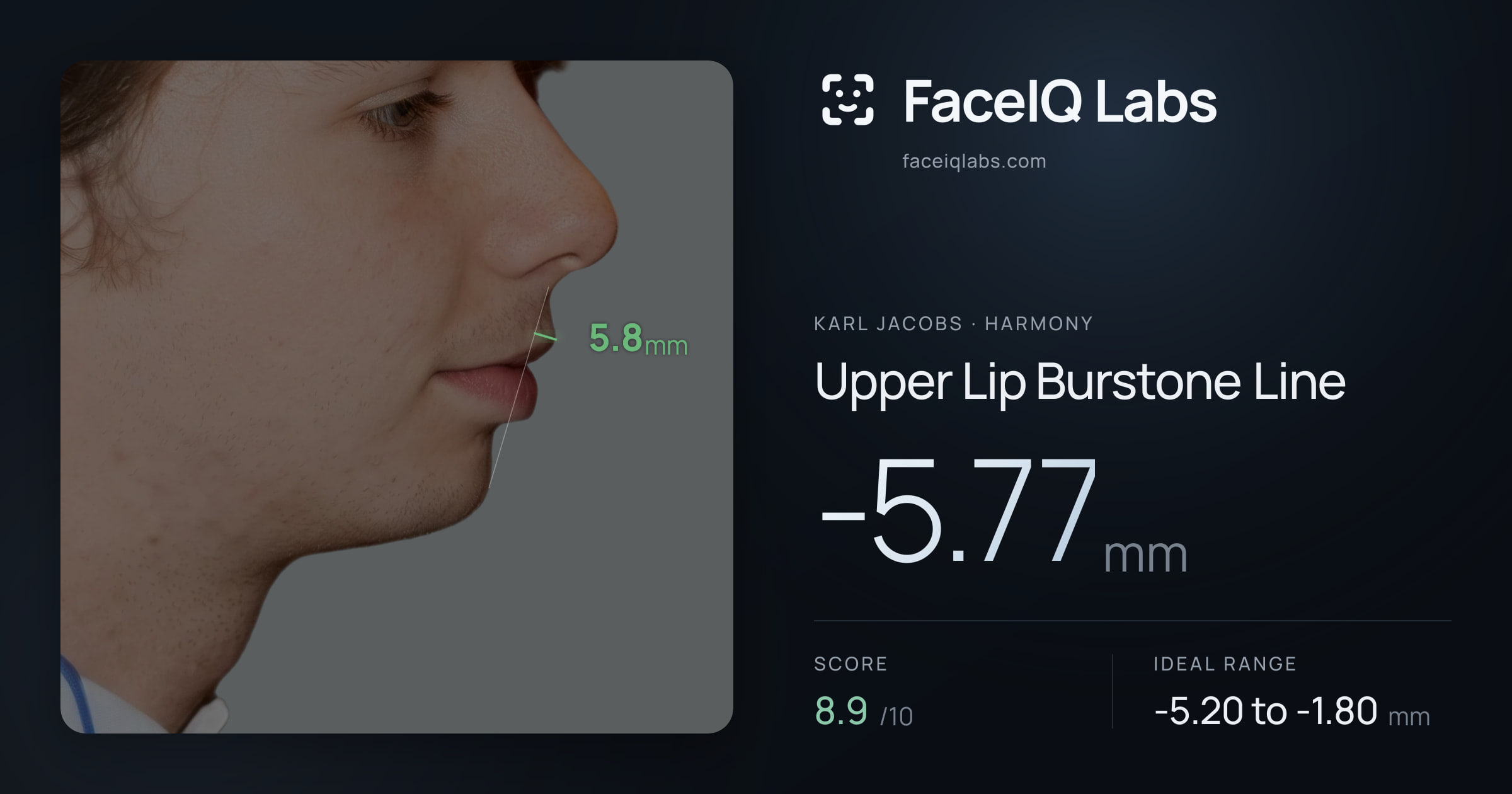 Karl Jacobs Upper Lip Burstone Line: -5.77mm, drawn on the photo