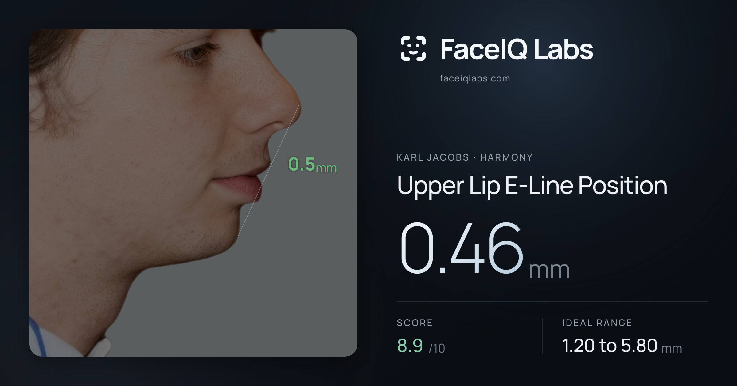 Karl Jacobs Upper Lip E-Line Position: 0.46mm, drawn on the photo