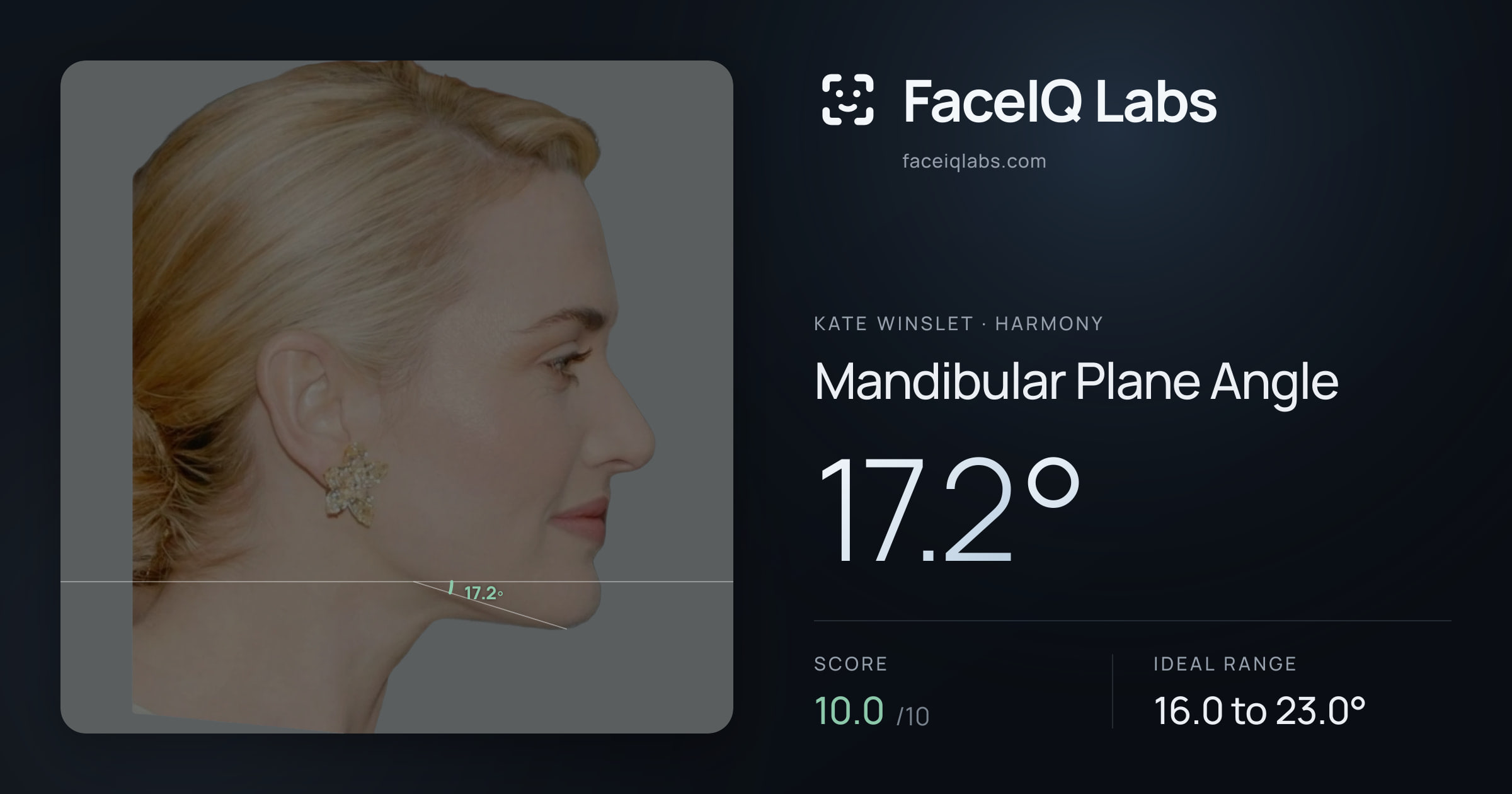 Kate Winslet Mandibular Plane Angle: 17.2°, drawn on the photo
