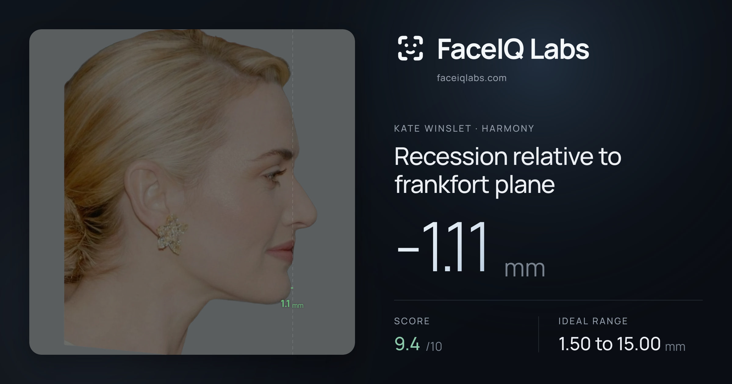 Kate Winslet Recession relative to frankfort plane: -1.11mm, drawn on the photo