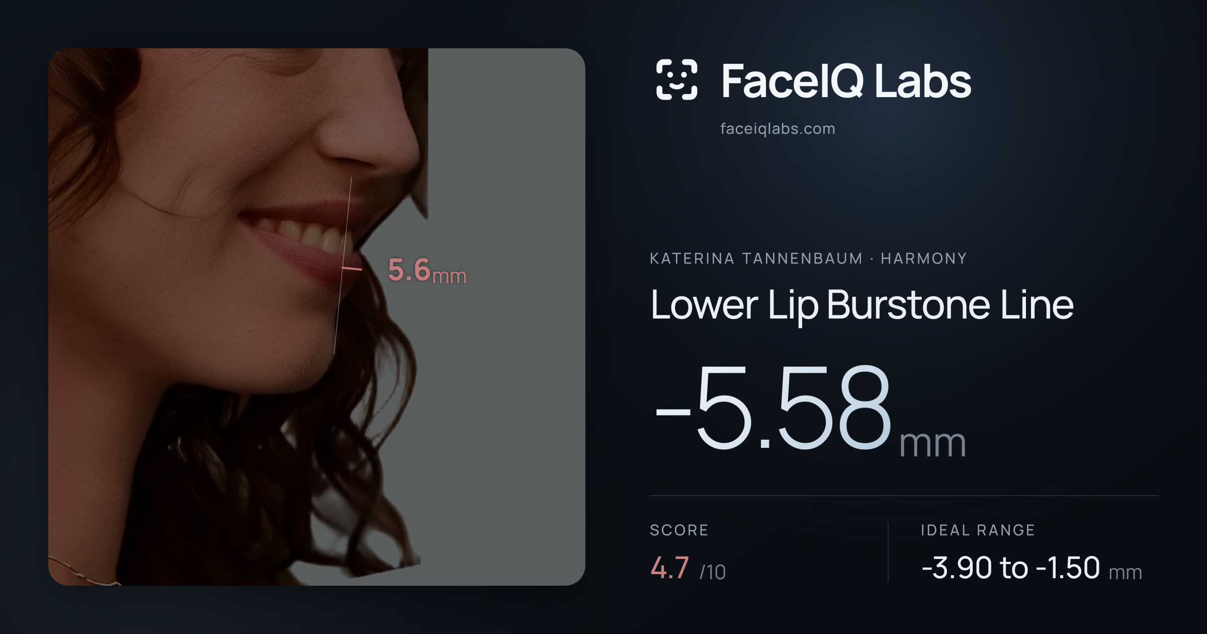 Katerina Tannenbaum Lower Lip Burstone Line: -5.58mm, drawn on the photo