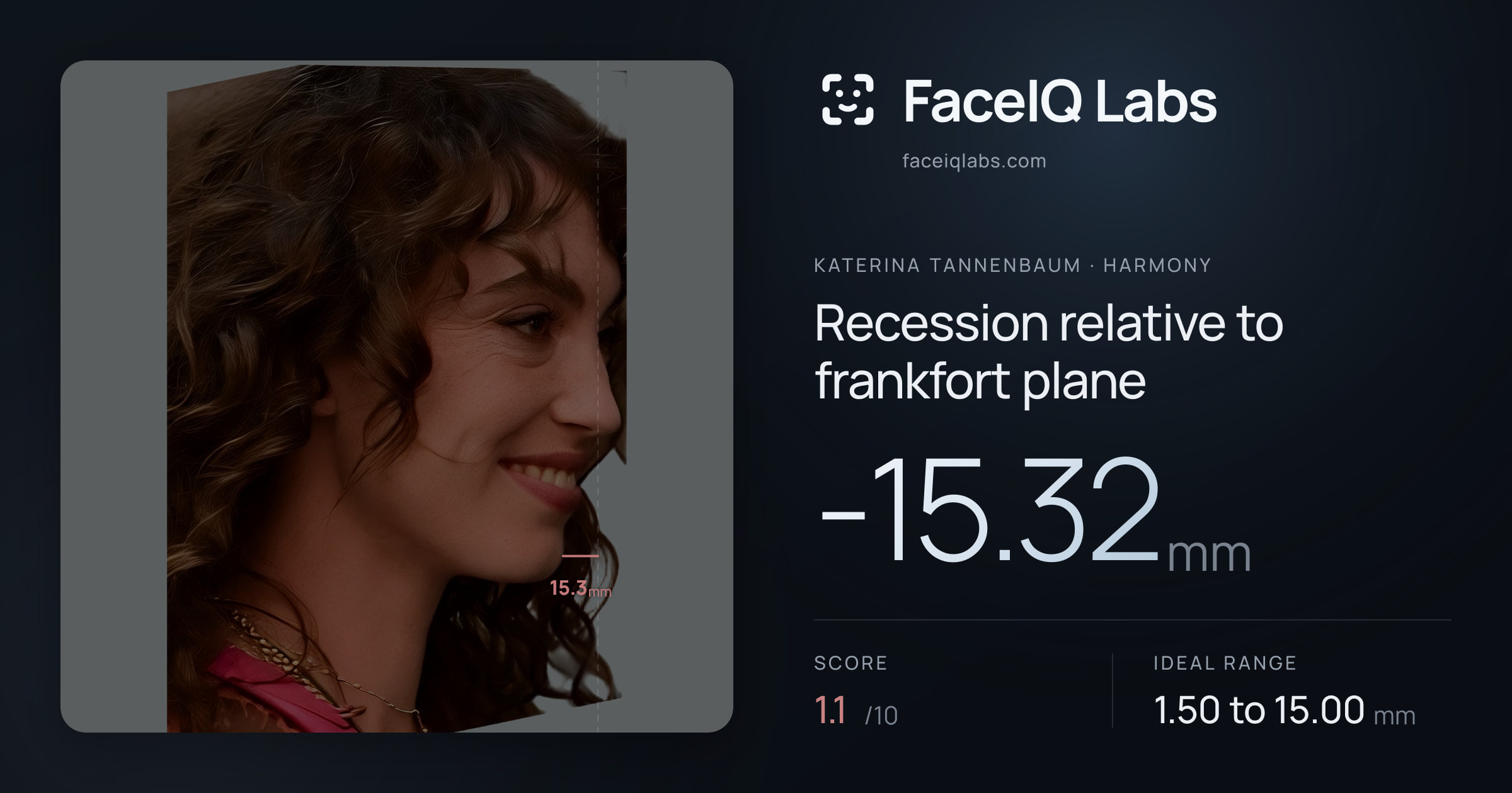 Katerina Tannenbaum Recession relative to frankfort plane: -15.32mm, drawn on the photo