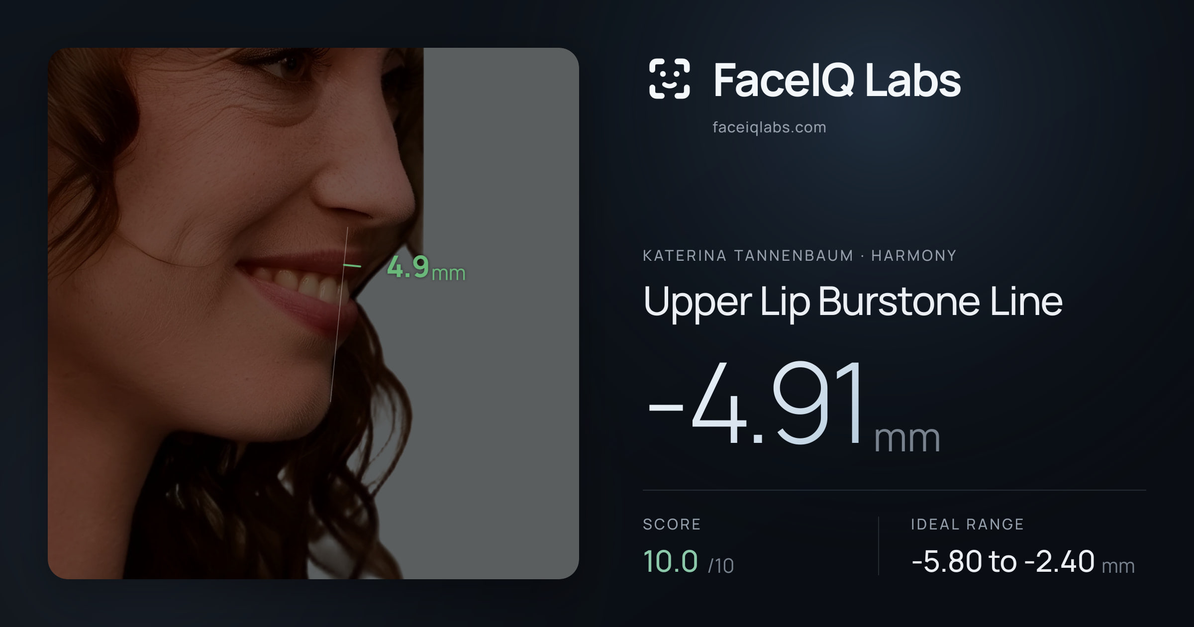 Katerina Tannenbaum Upper Lip Burstone Line: -4.91mm, drawn on the photo