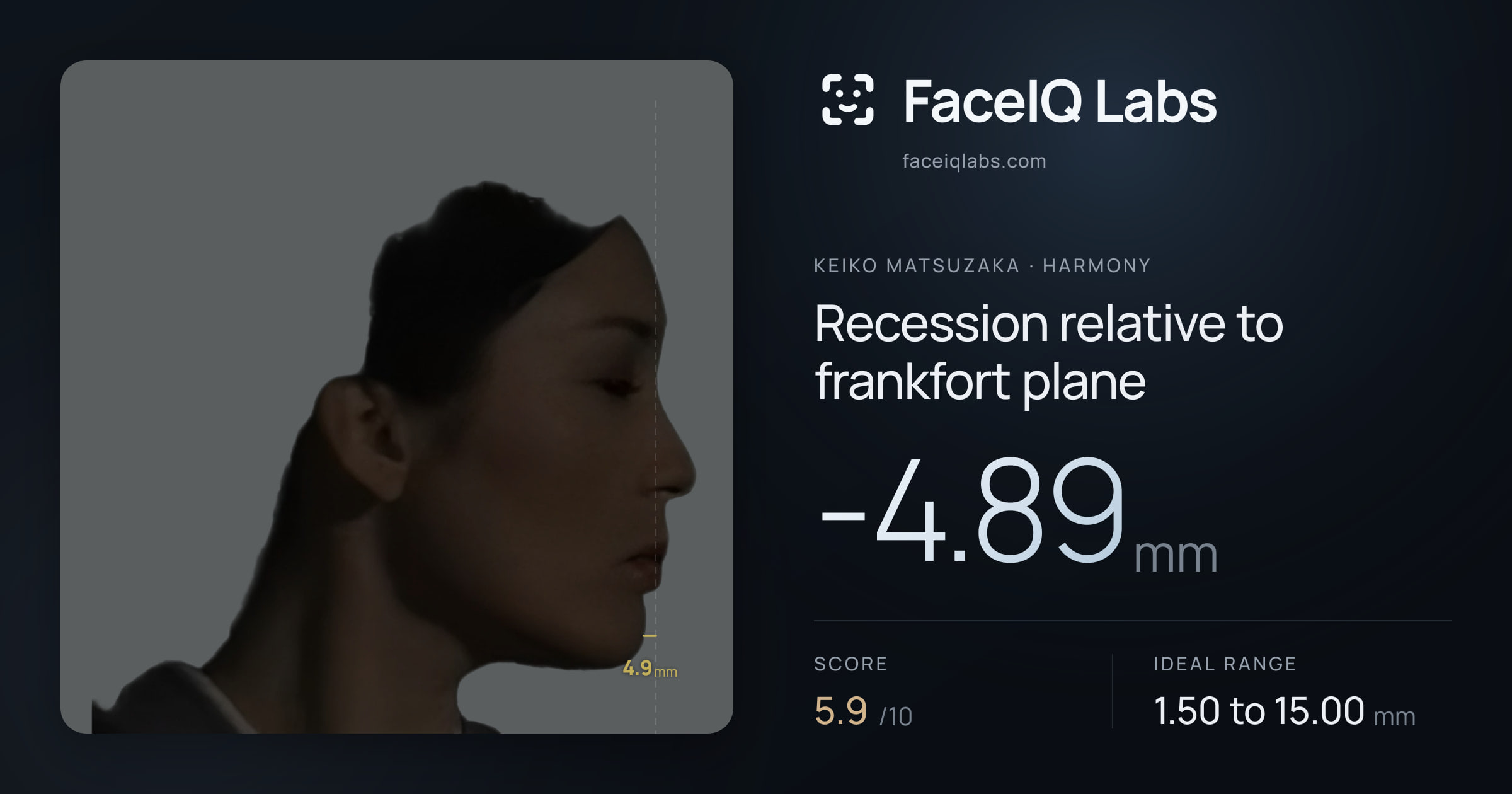 Keiko Matsuzaka Recession relative to frankfort plane: -4.89mm, drawn on the photo
