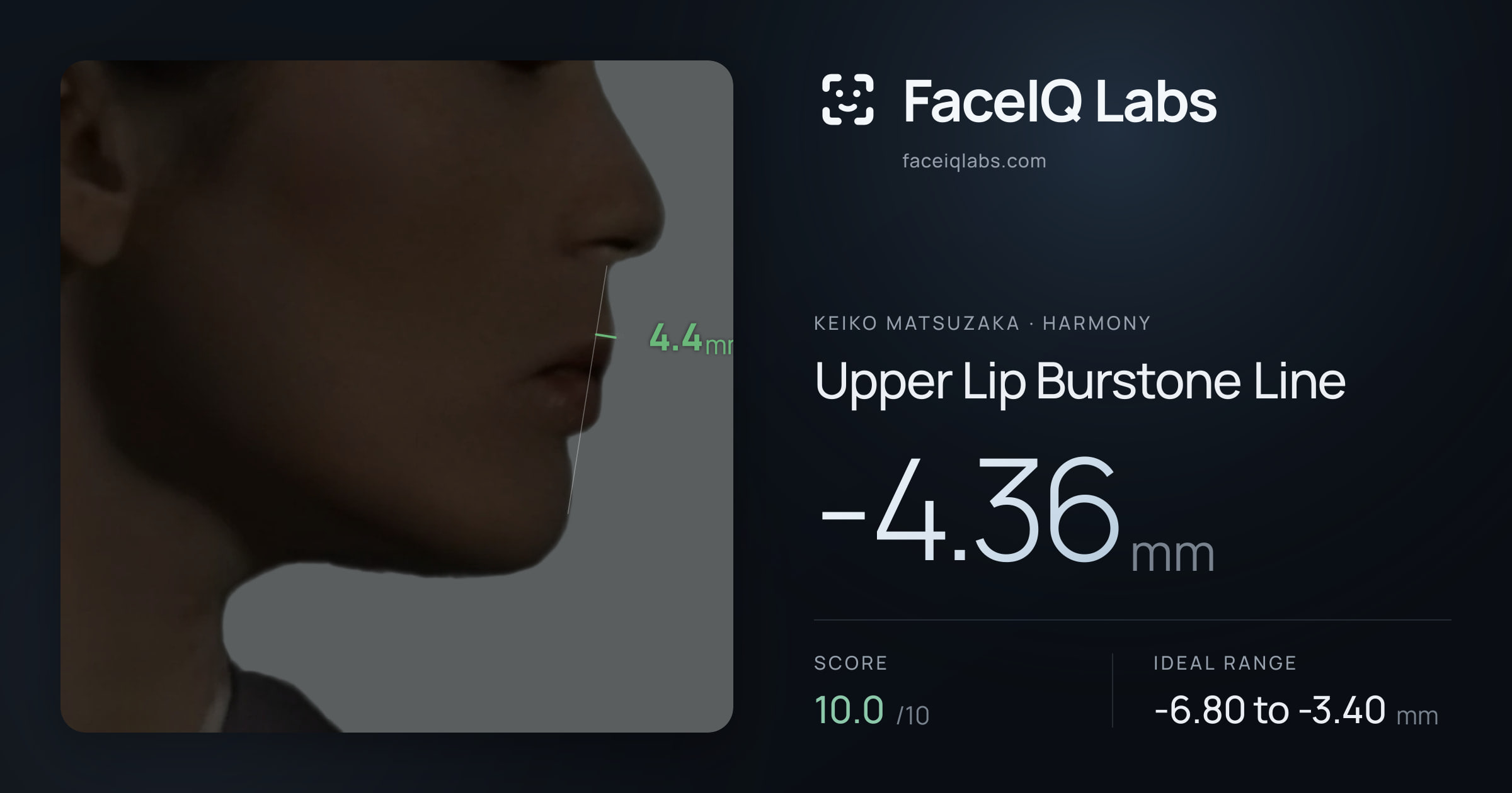 Keiko Matsuzaka Upper Lip Burstone Line: -4.36mm, drawn on the photo