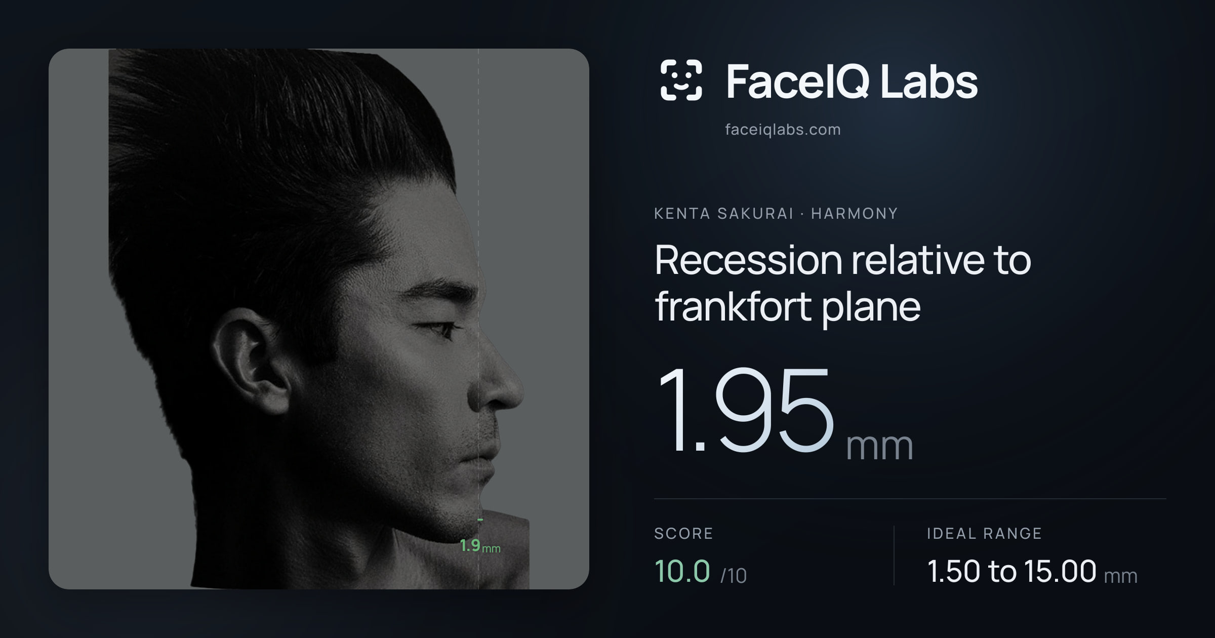 Kenta Sakurai Recession relative to frankfort plane: 1.95mm, drawn on the photo