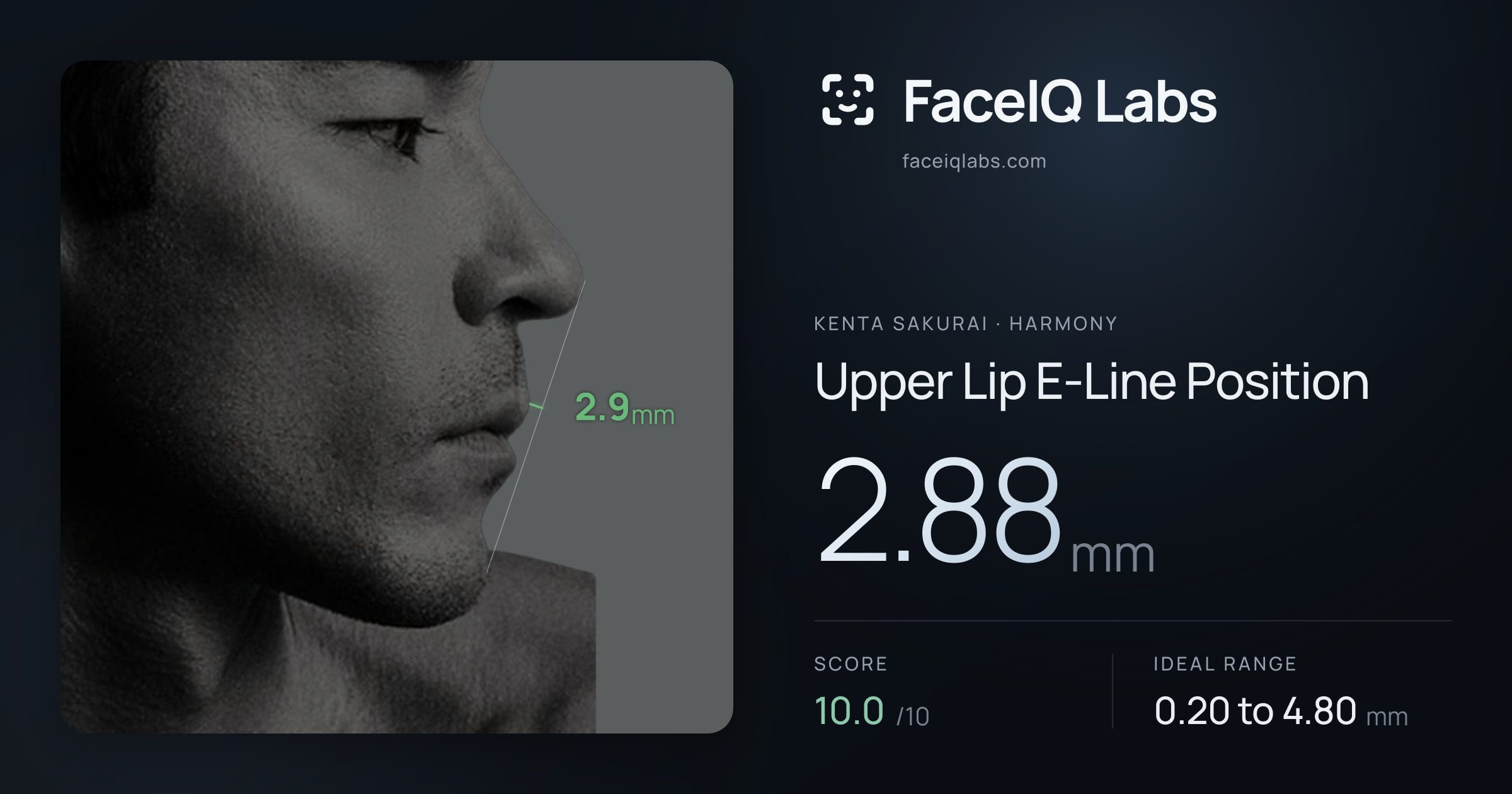 Kenta Sakurai Upper Lip E-Line Position: 2.88mm, drawn on the photo
